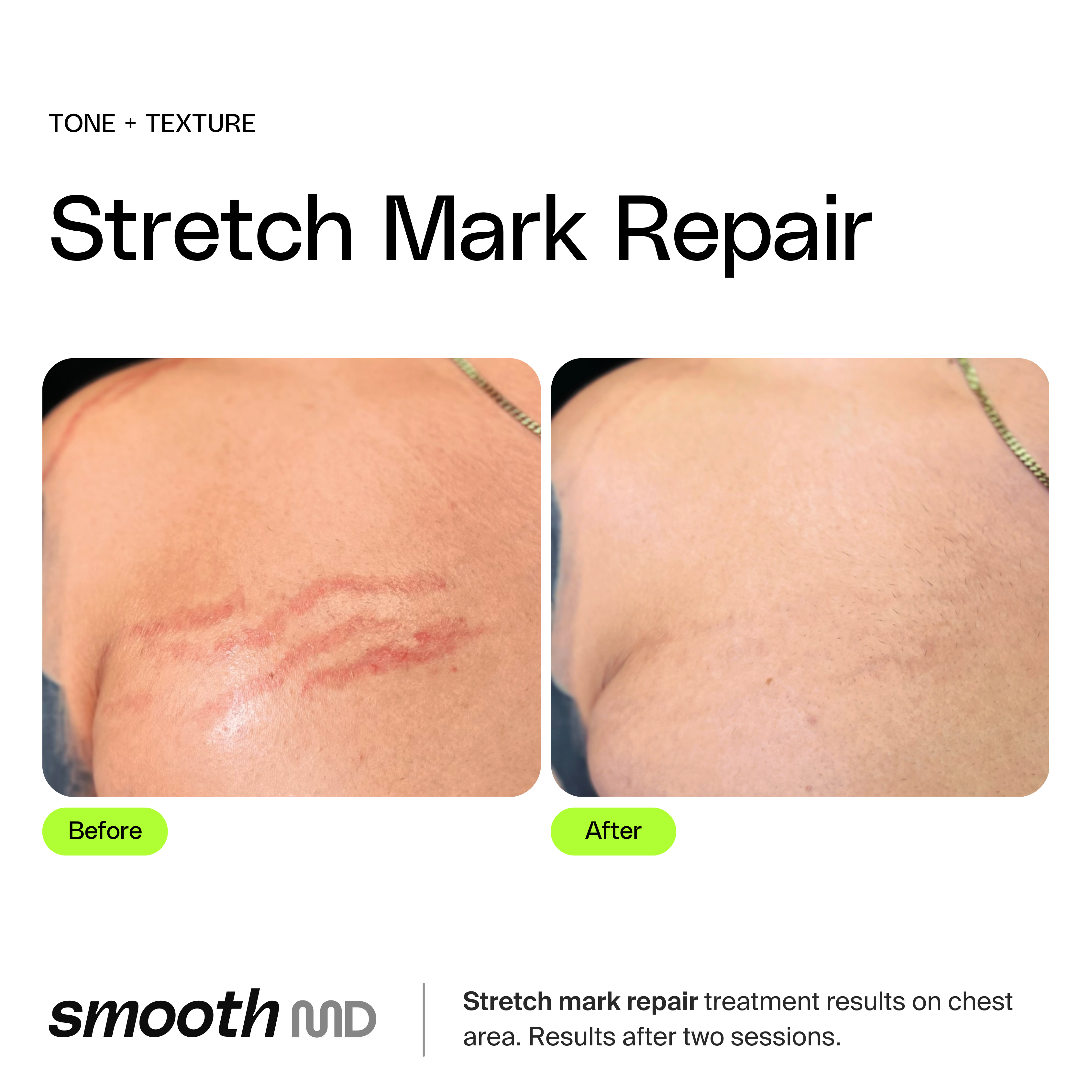 Stretch Mark Reduction