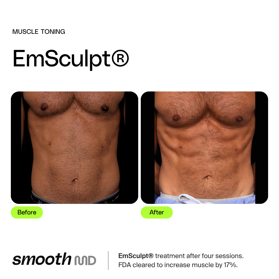 EmSculpt