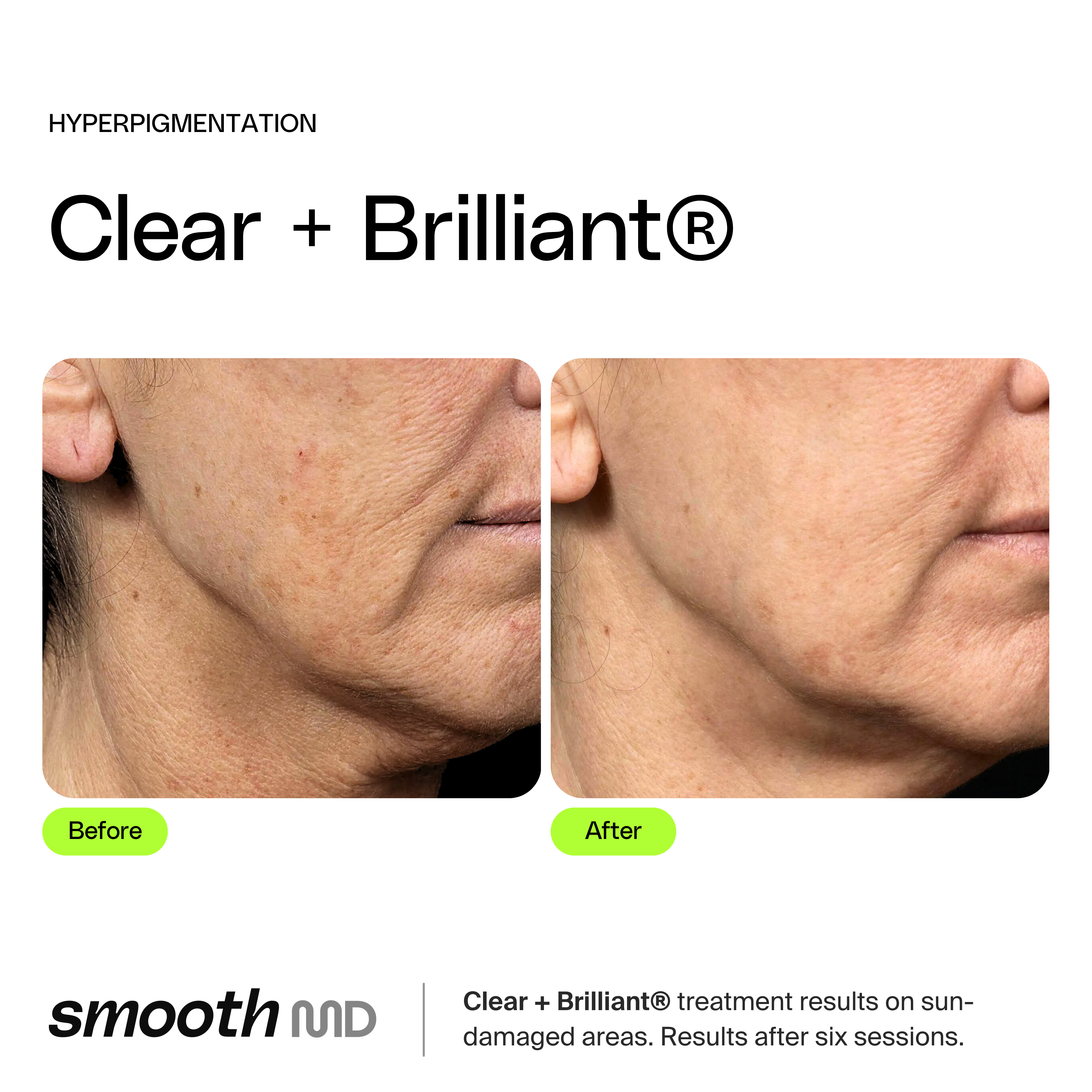 Clear + Brilliant Resurfacing Laser