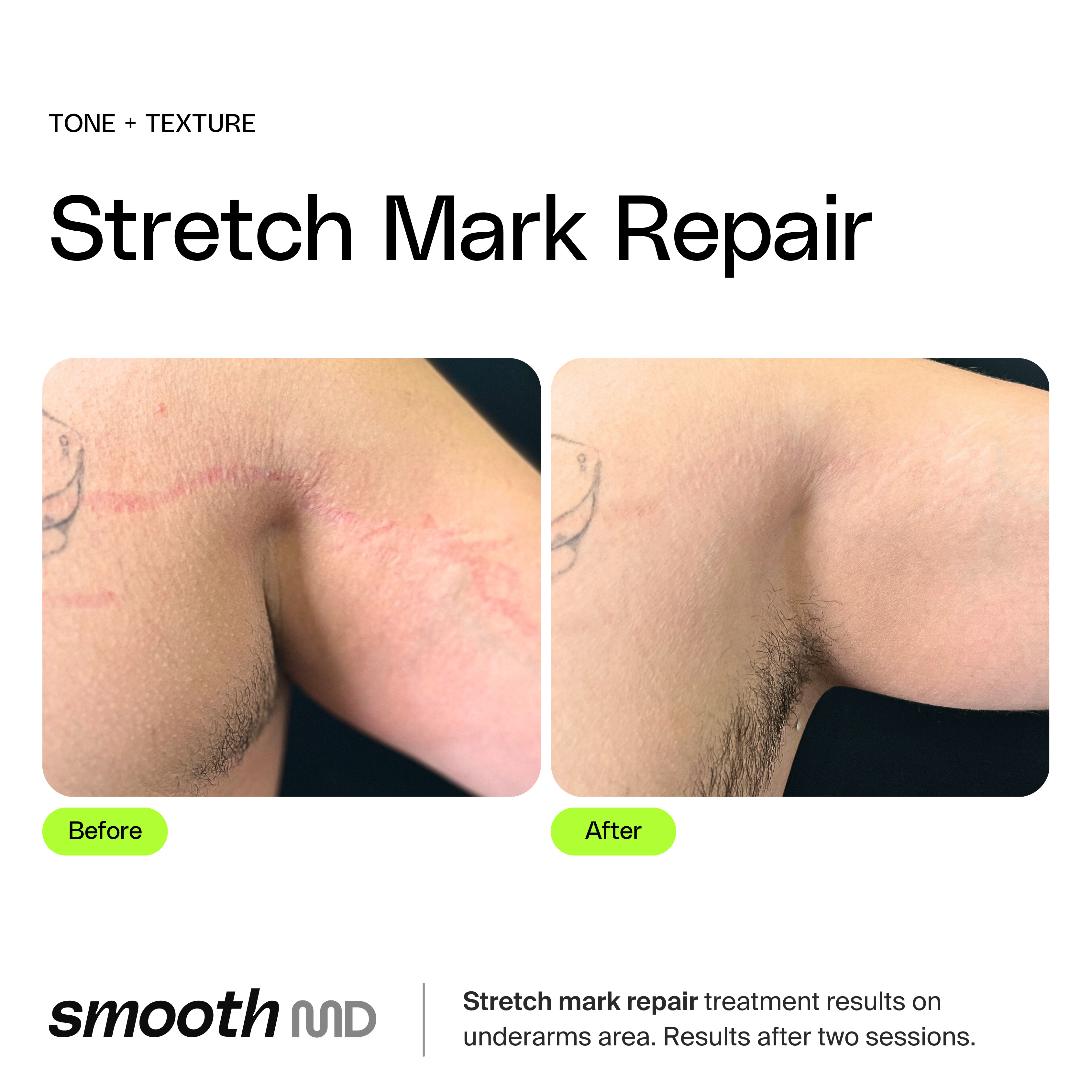 Stretch Mark Reduction