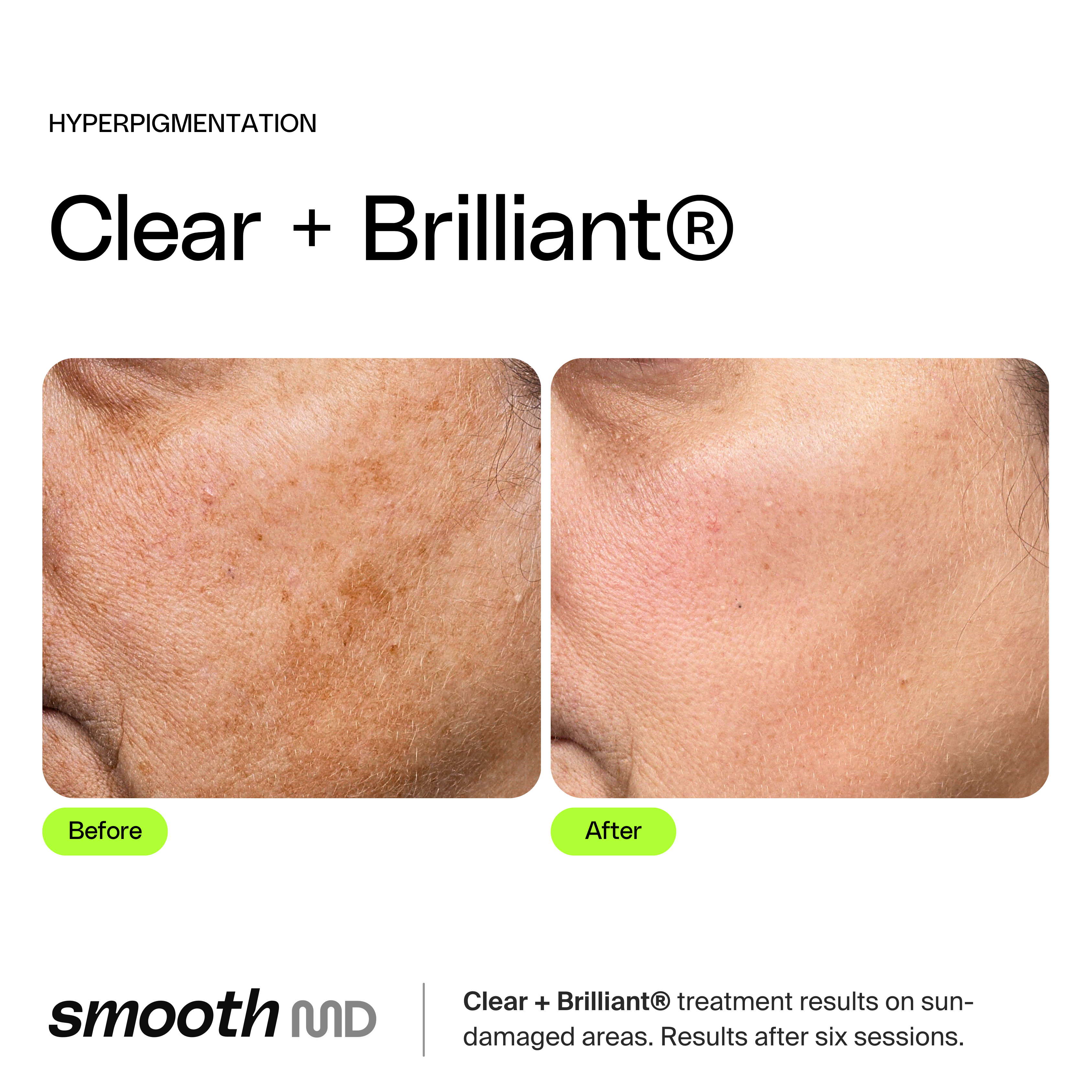 Clear + Brilliant Resurfacing Laser