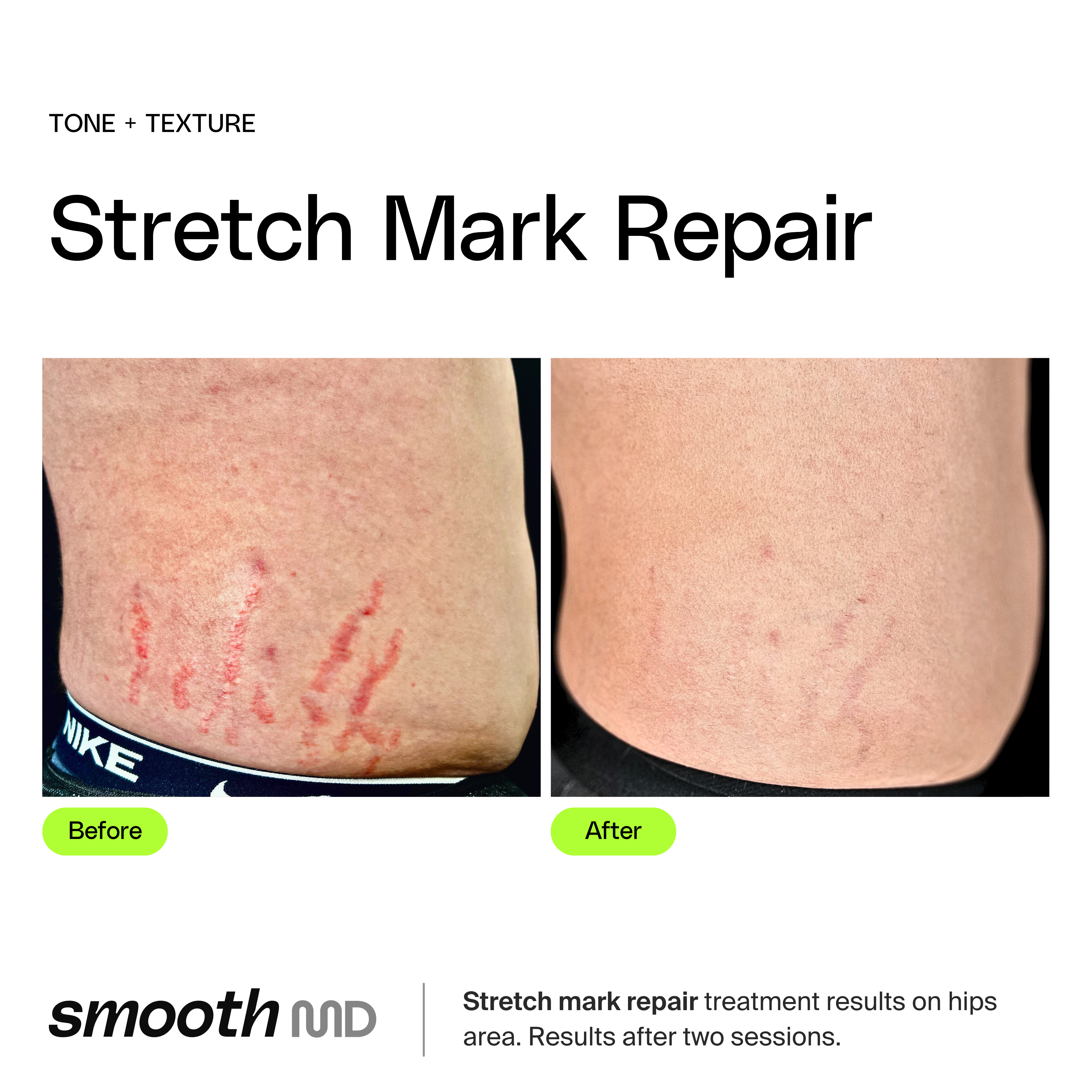 Stretch Mark Reduction