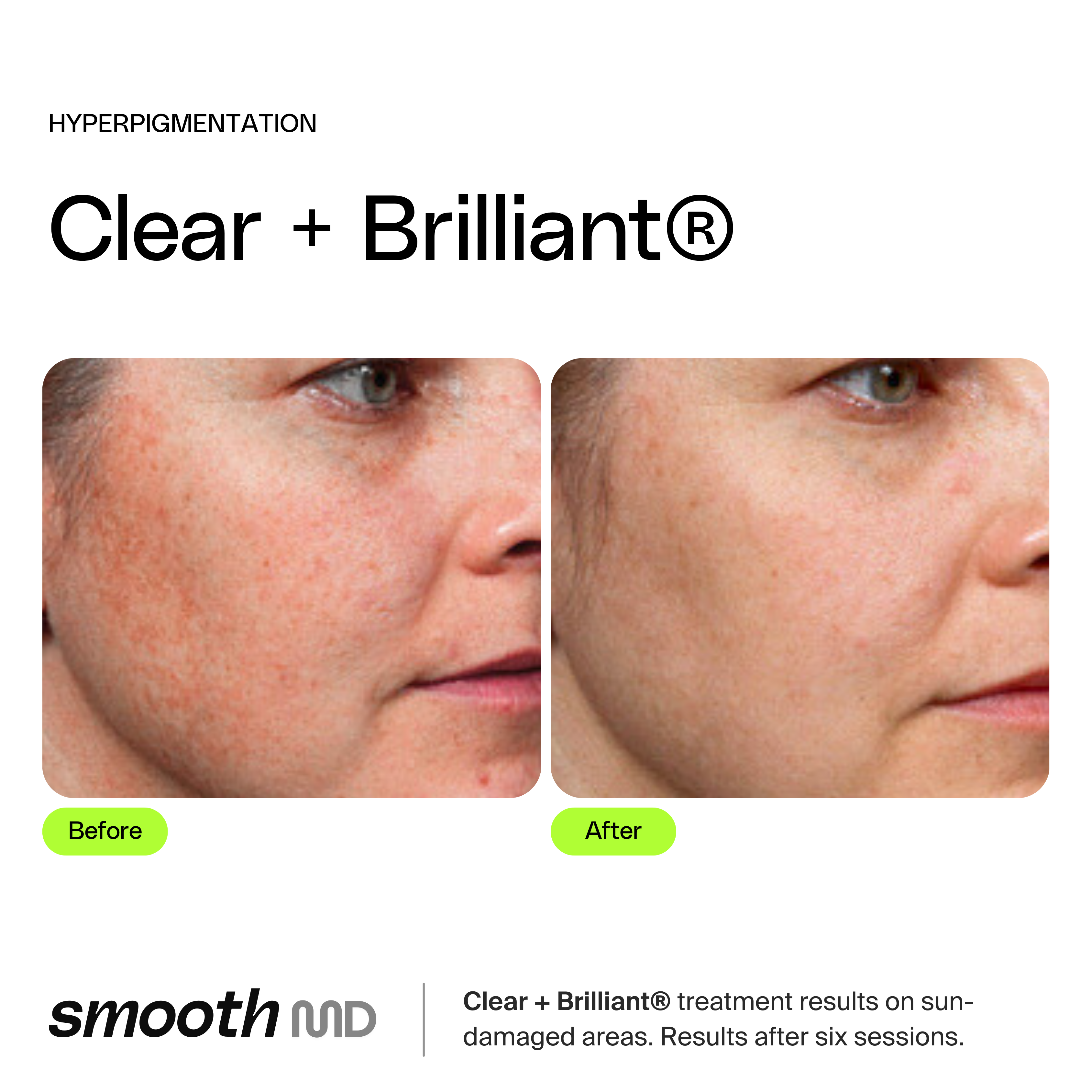Clear + Brilliant Resurfacing Laser