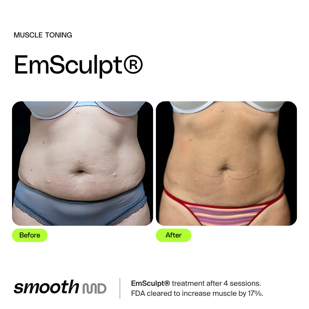 EmSculpt