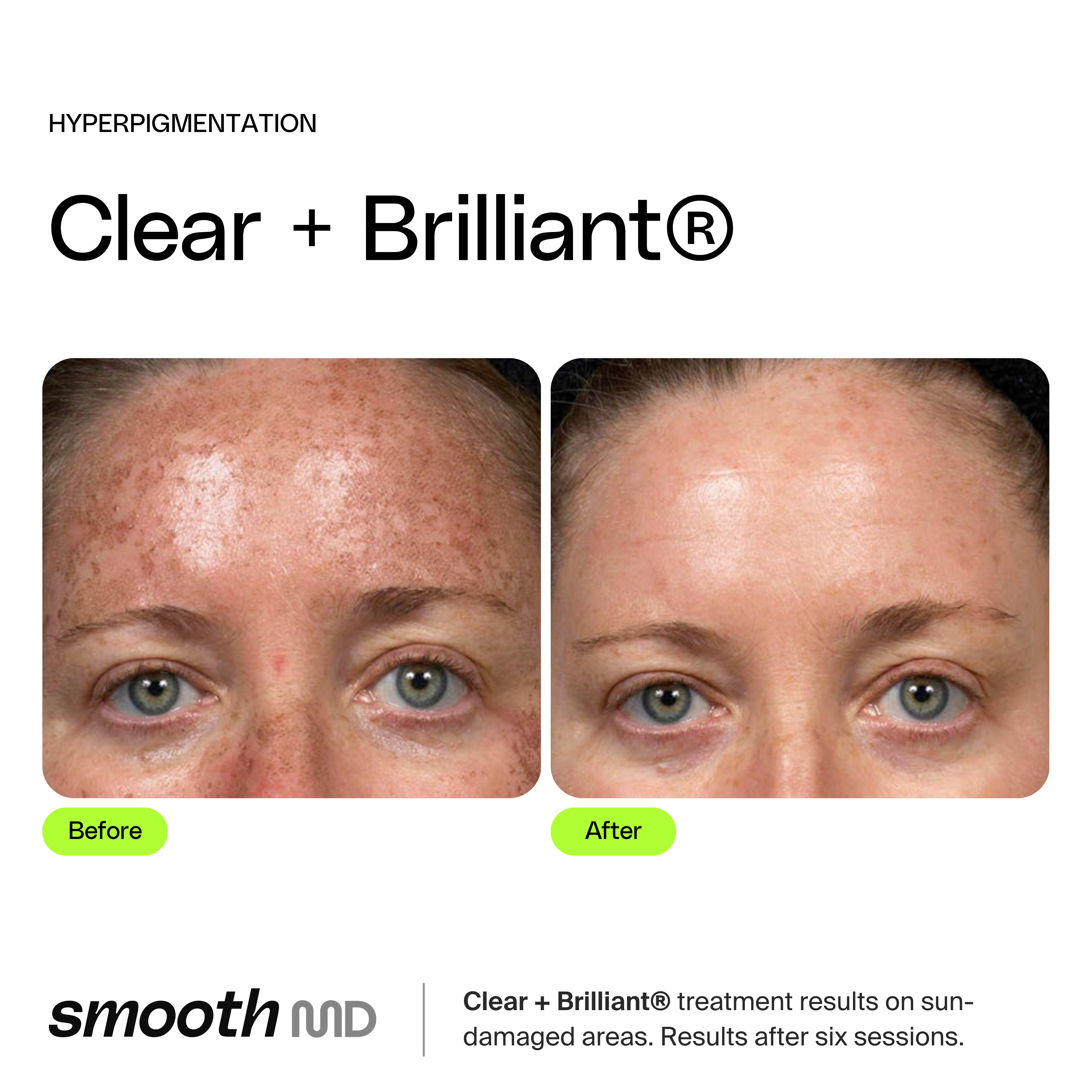 Clear + Brilliant Resurfacing Laser