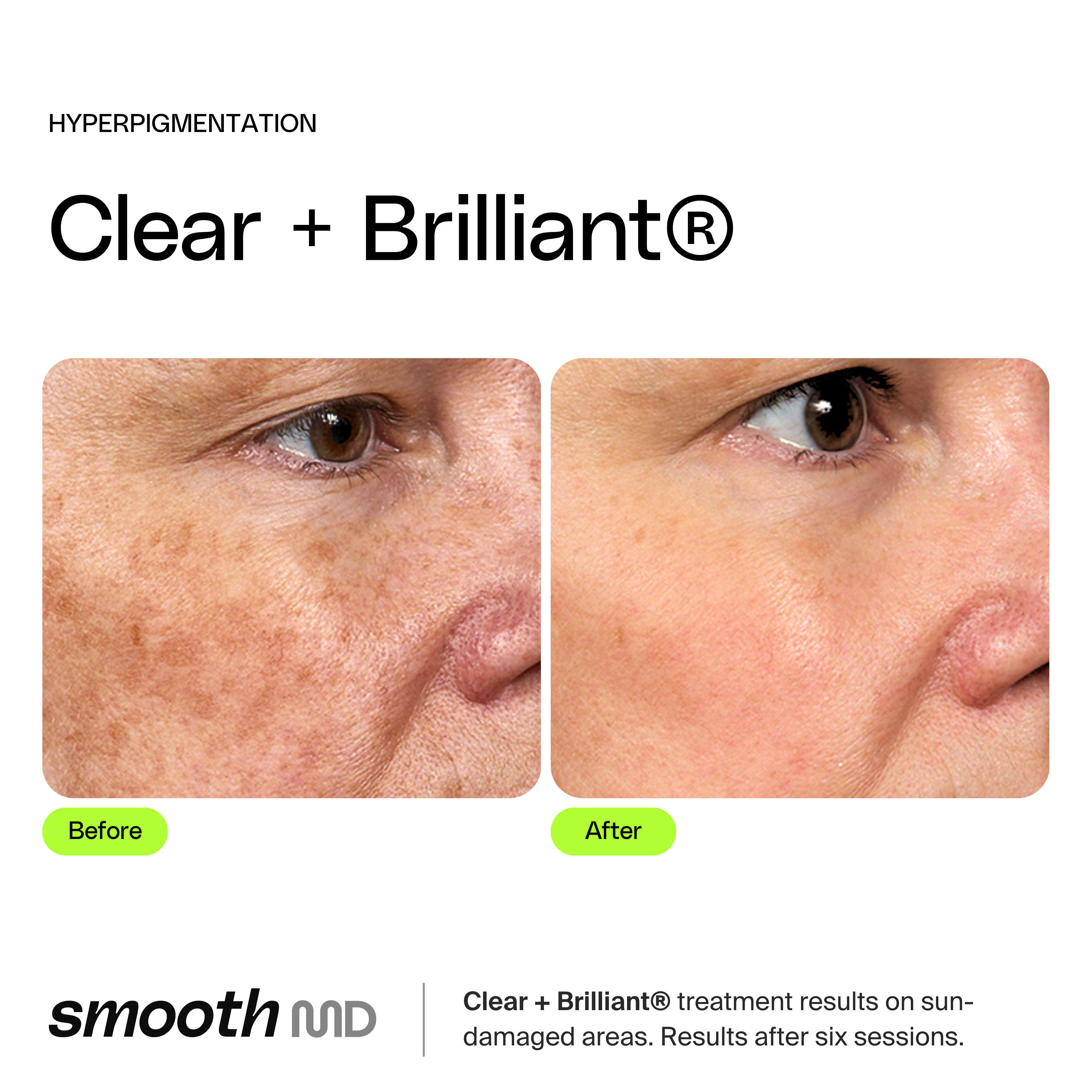 Clear + Brilliant Resurfacing Laser