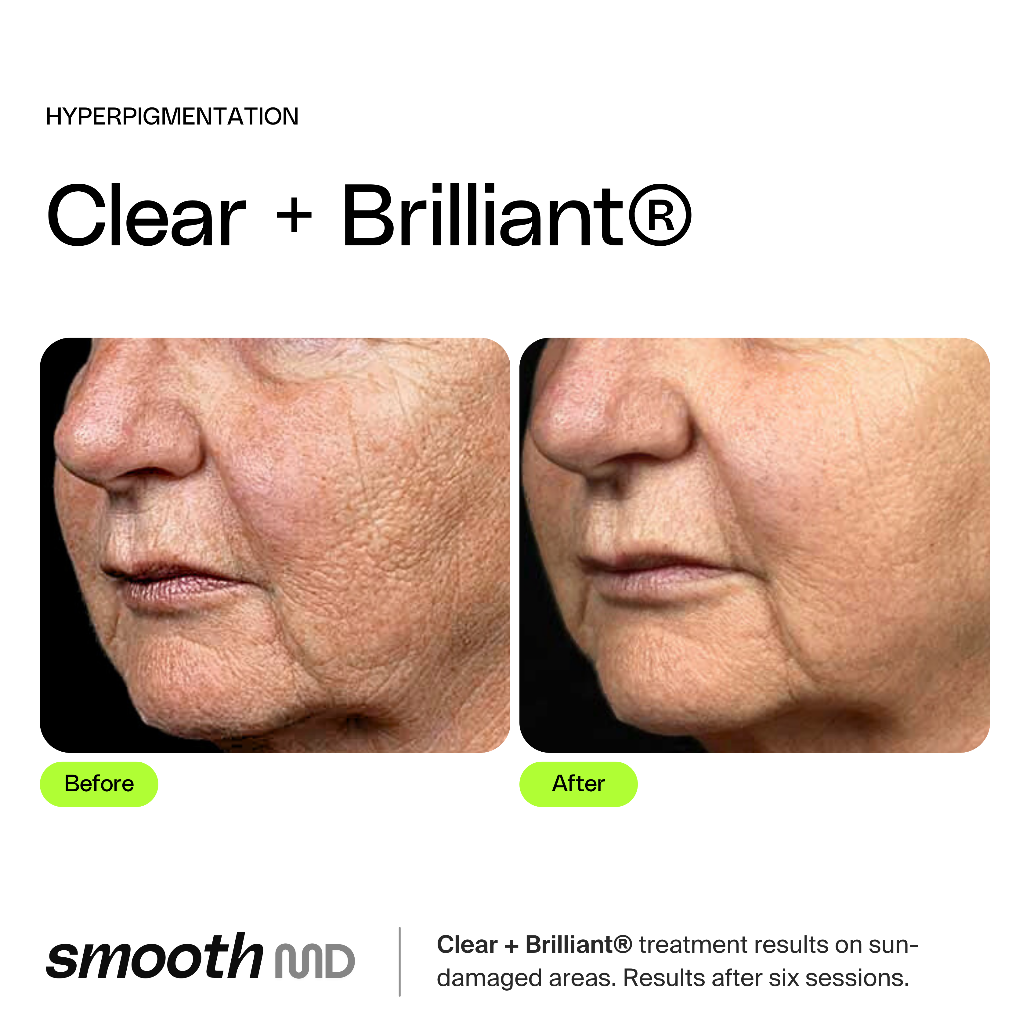 Clear + Brilliant Resurfacing Laser