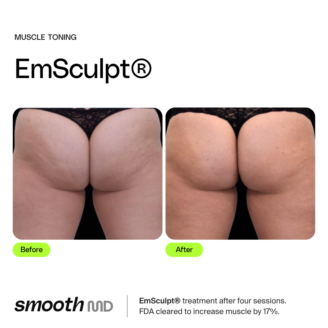 EmSculpt
