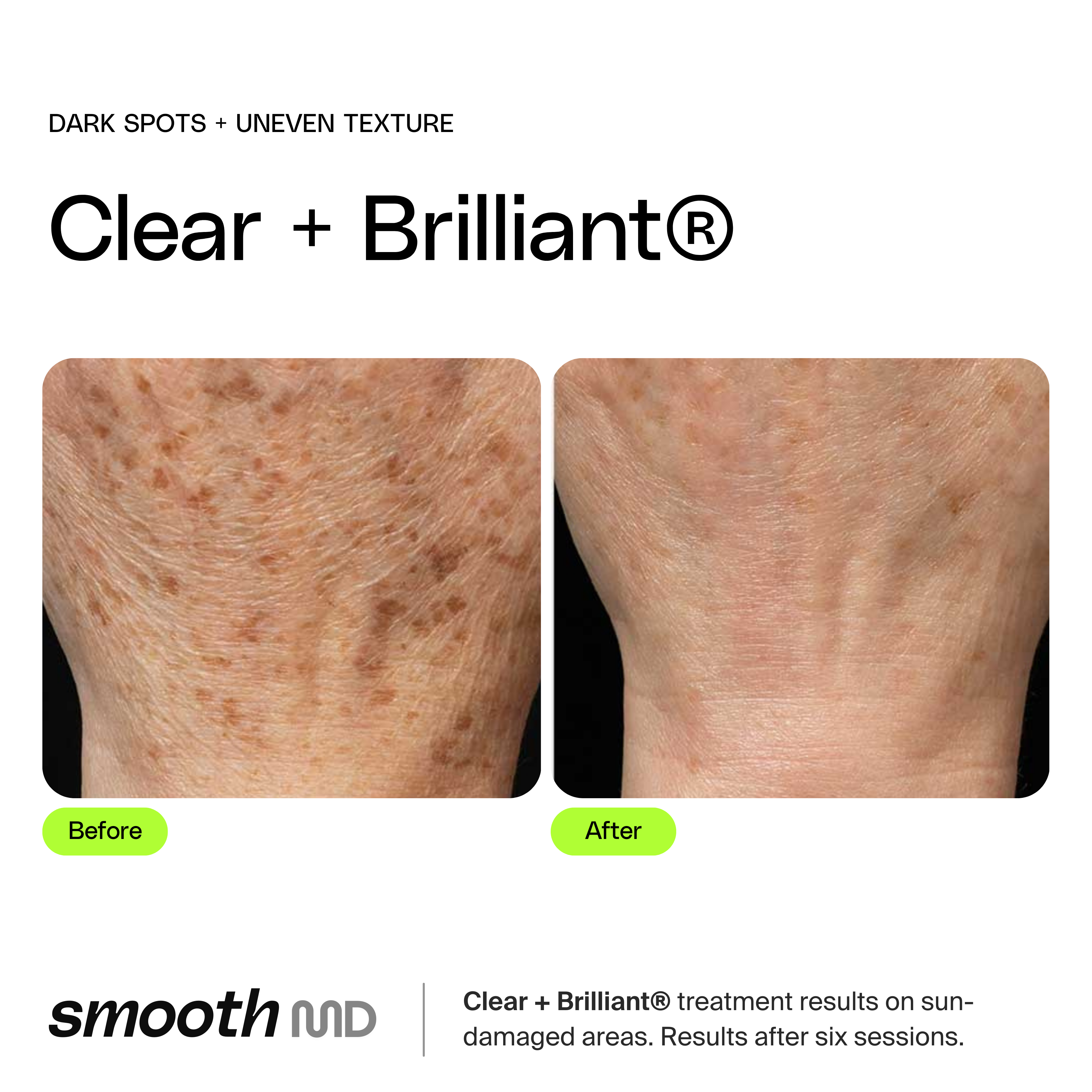 Clear + Brilliant Resurfacing Laser