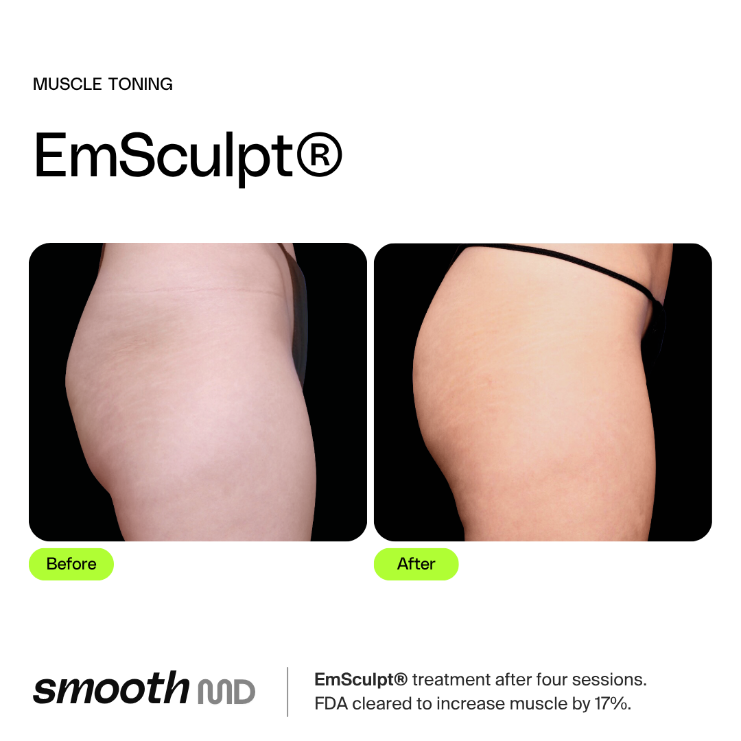EmSculpt