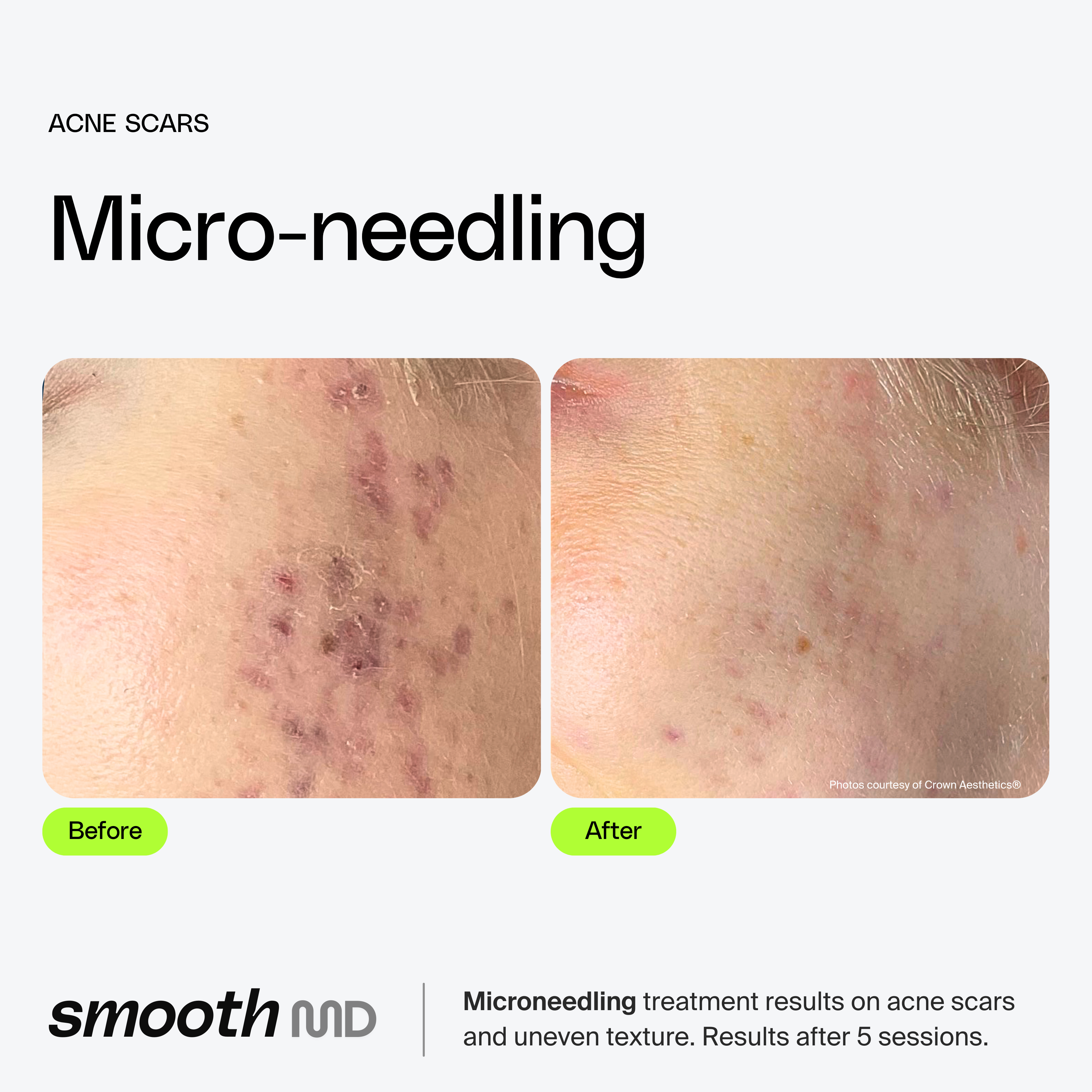 Microneedling