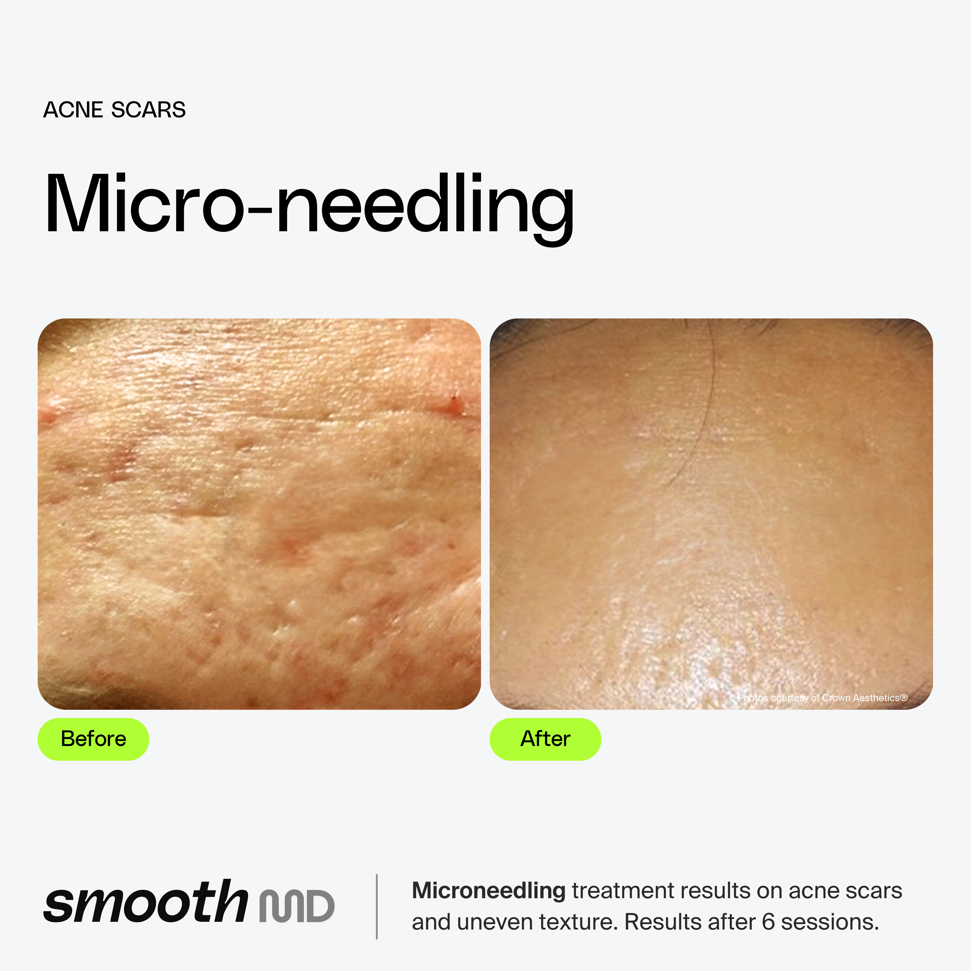 Microneedling