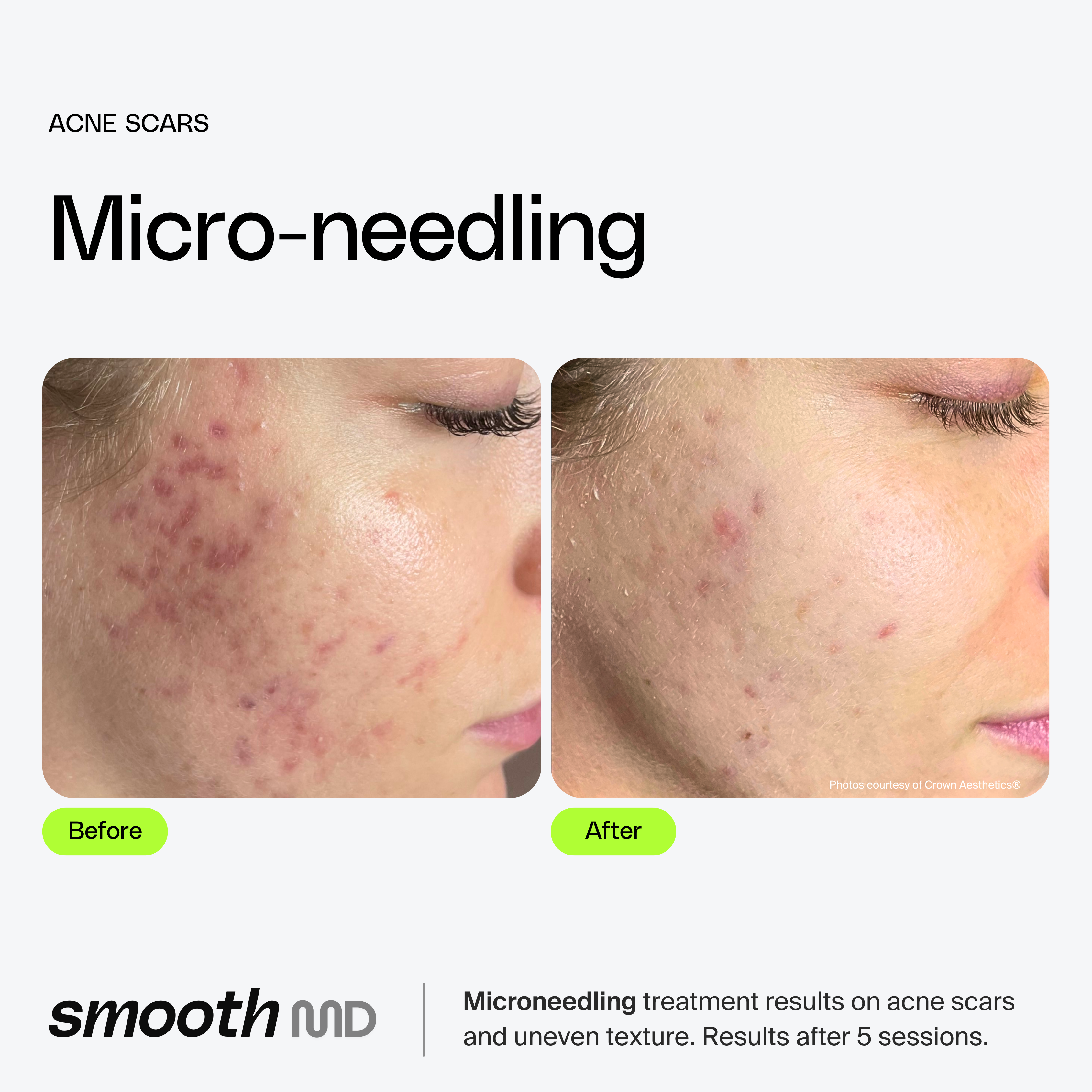 Microneedling