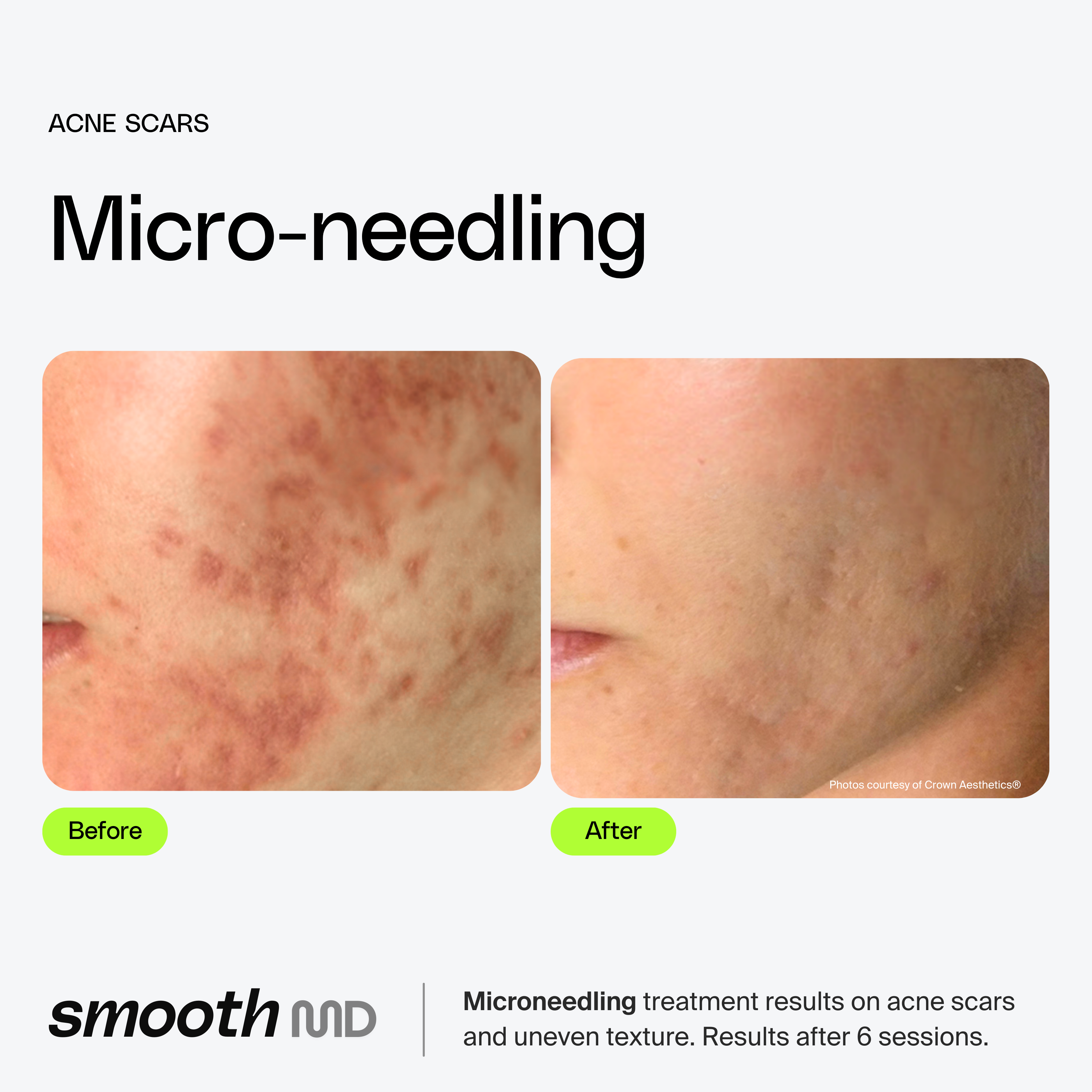 Microneedling