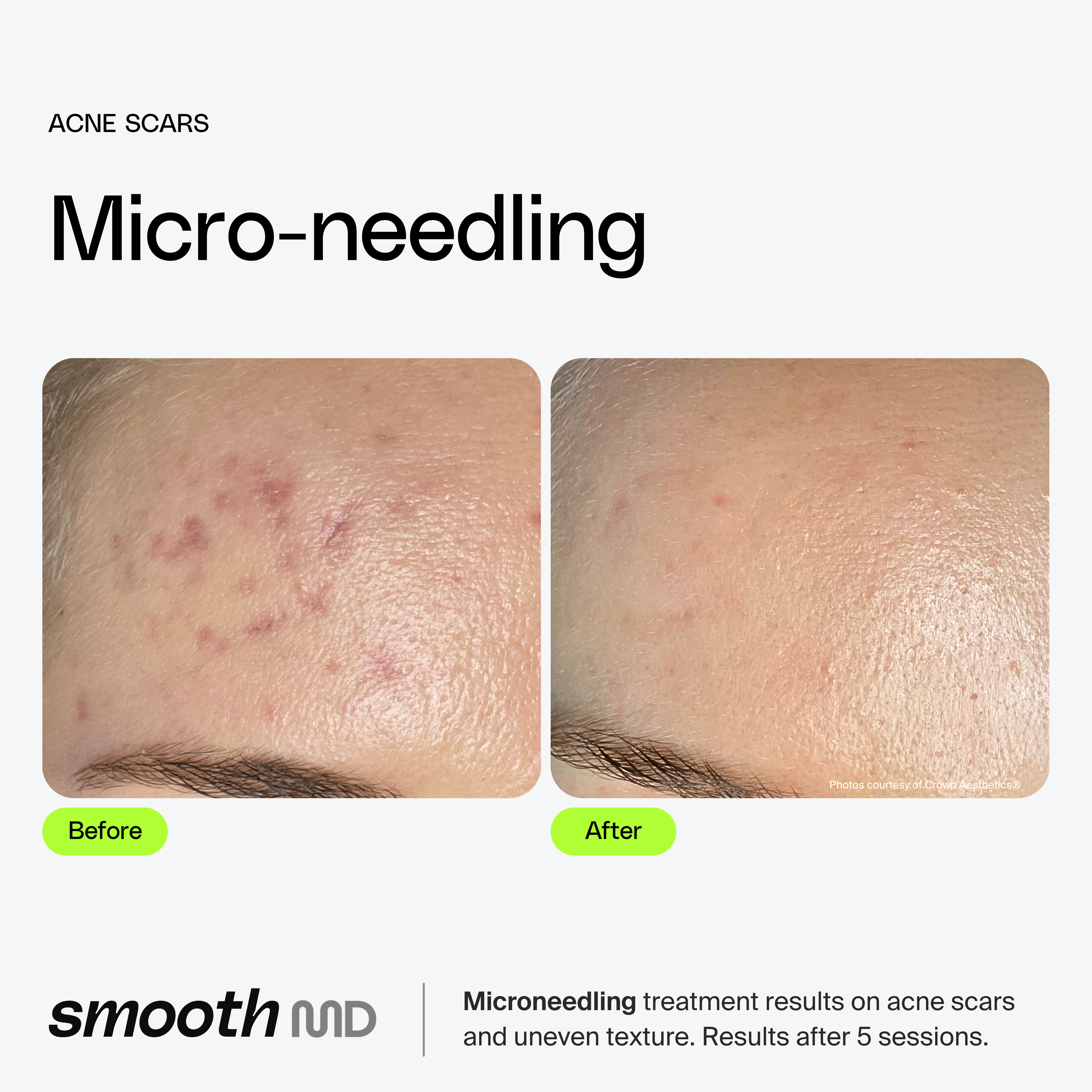 Microneedling