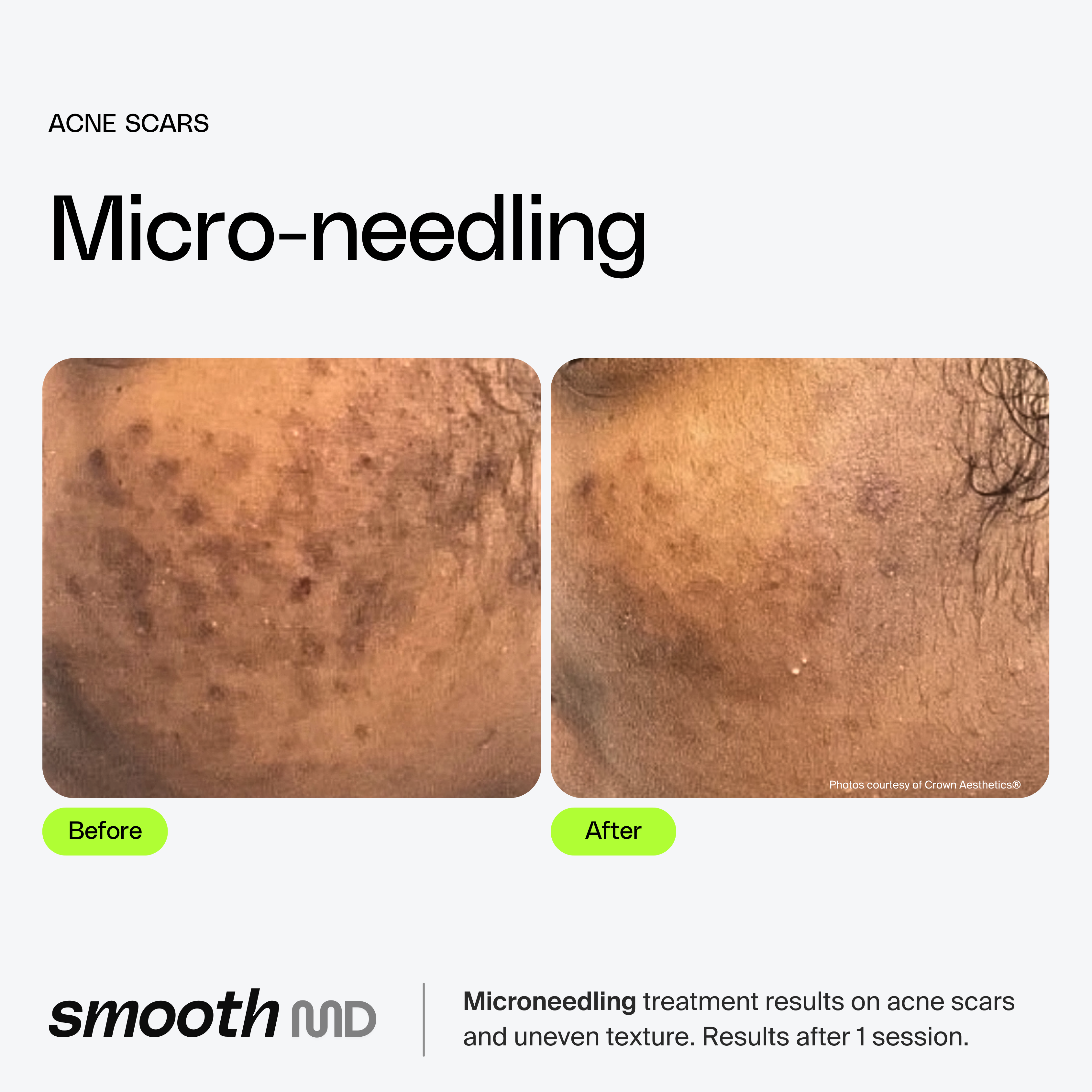Microneedling