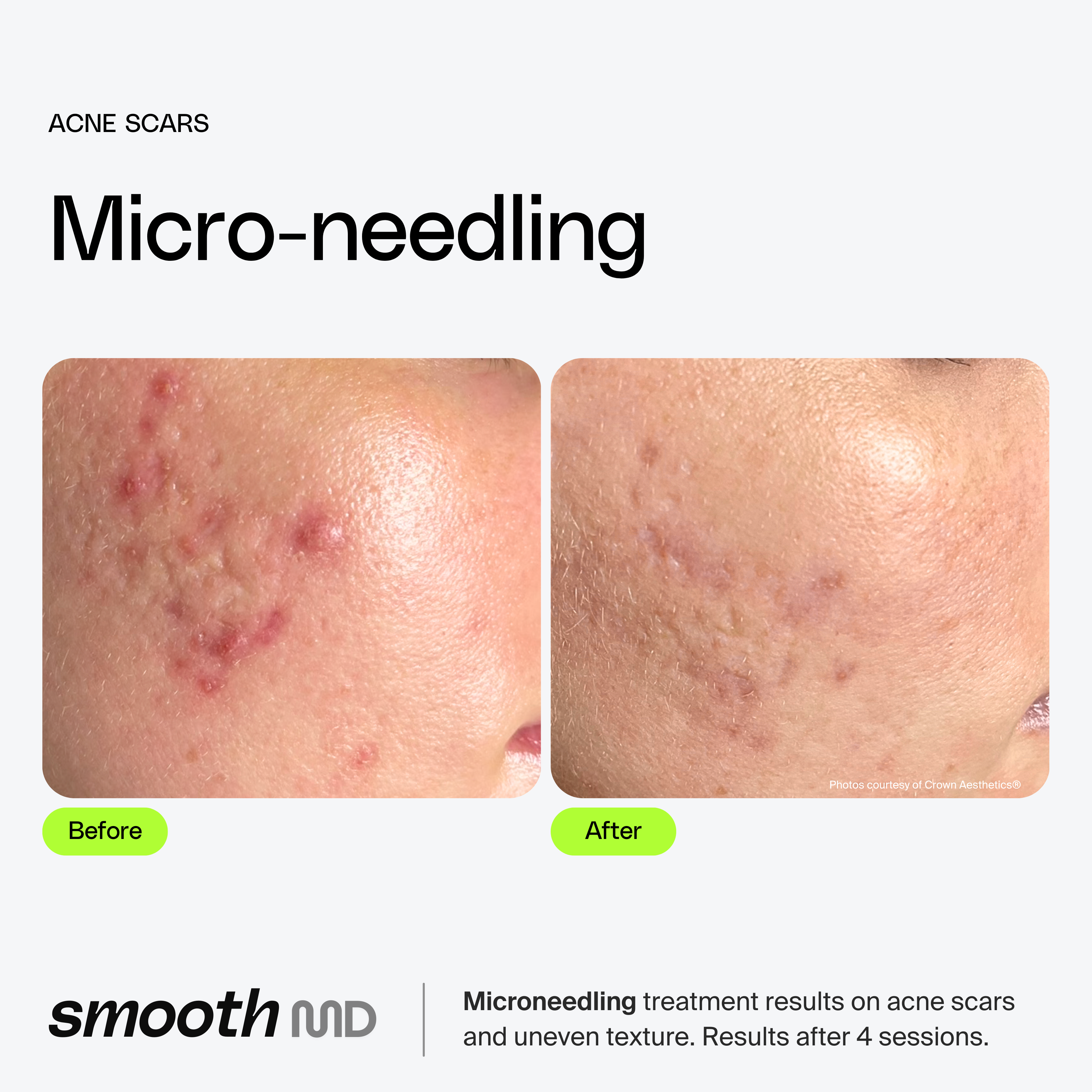 Microneedling