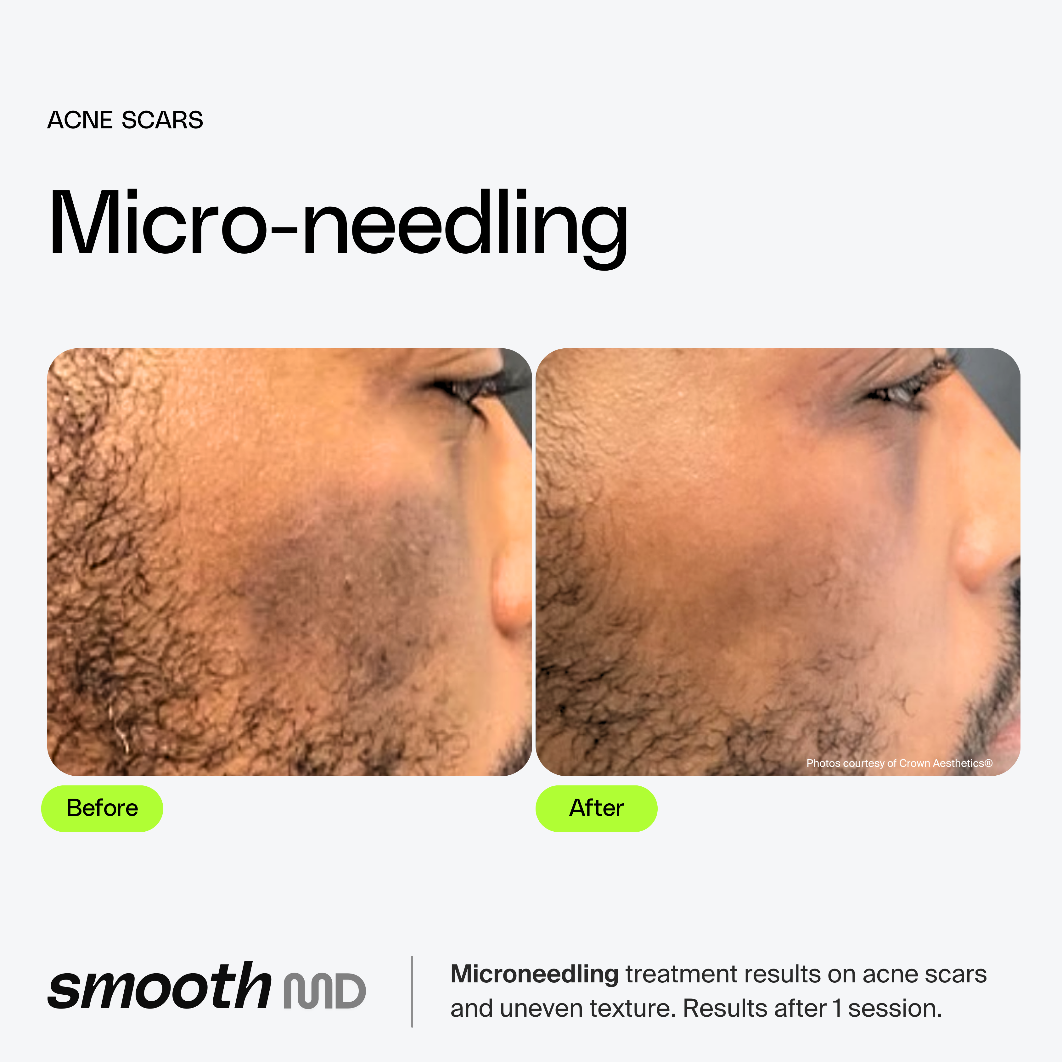 Microneedling