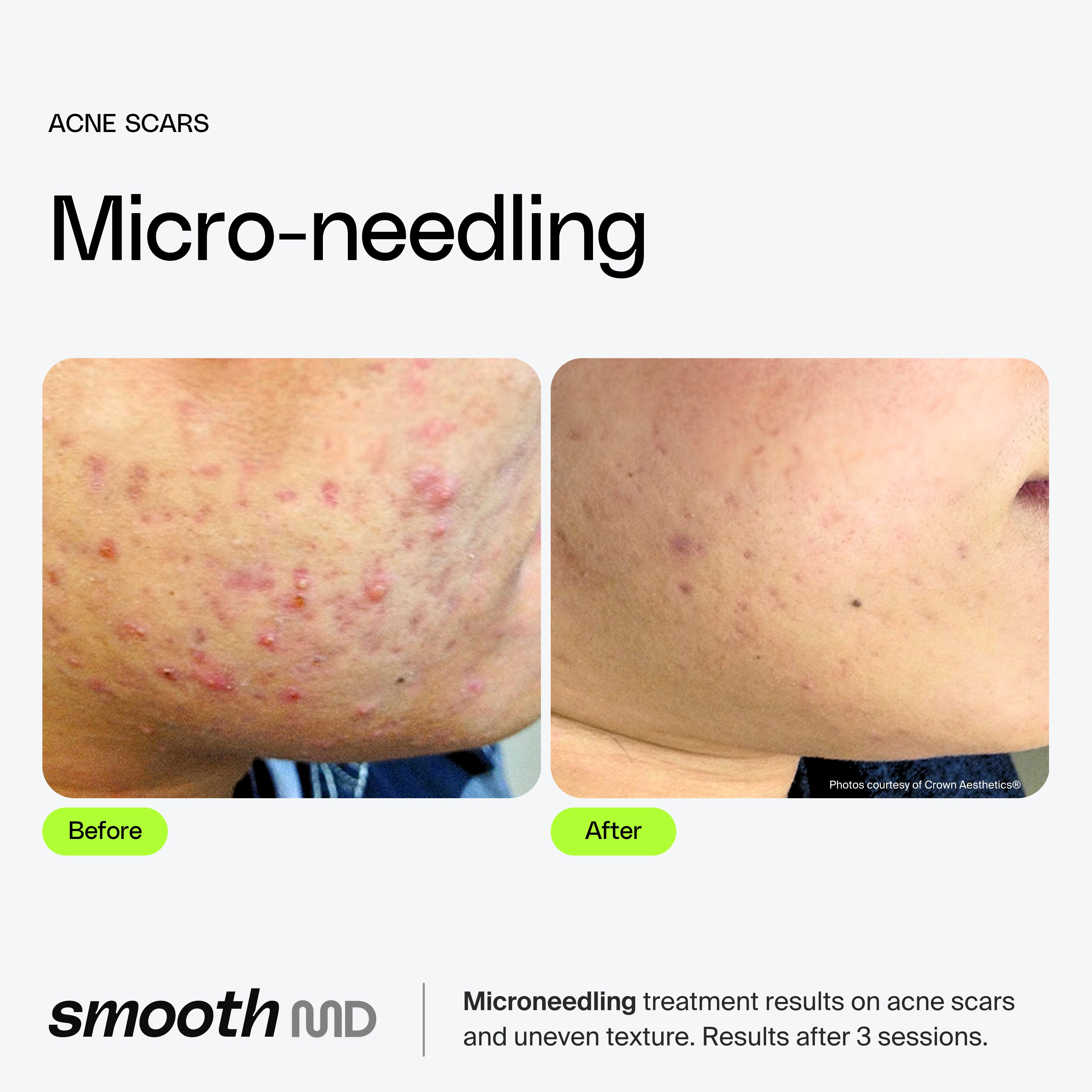 Microneedling
