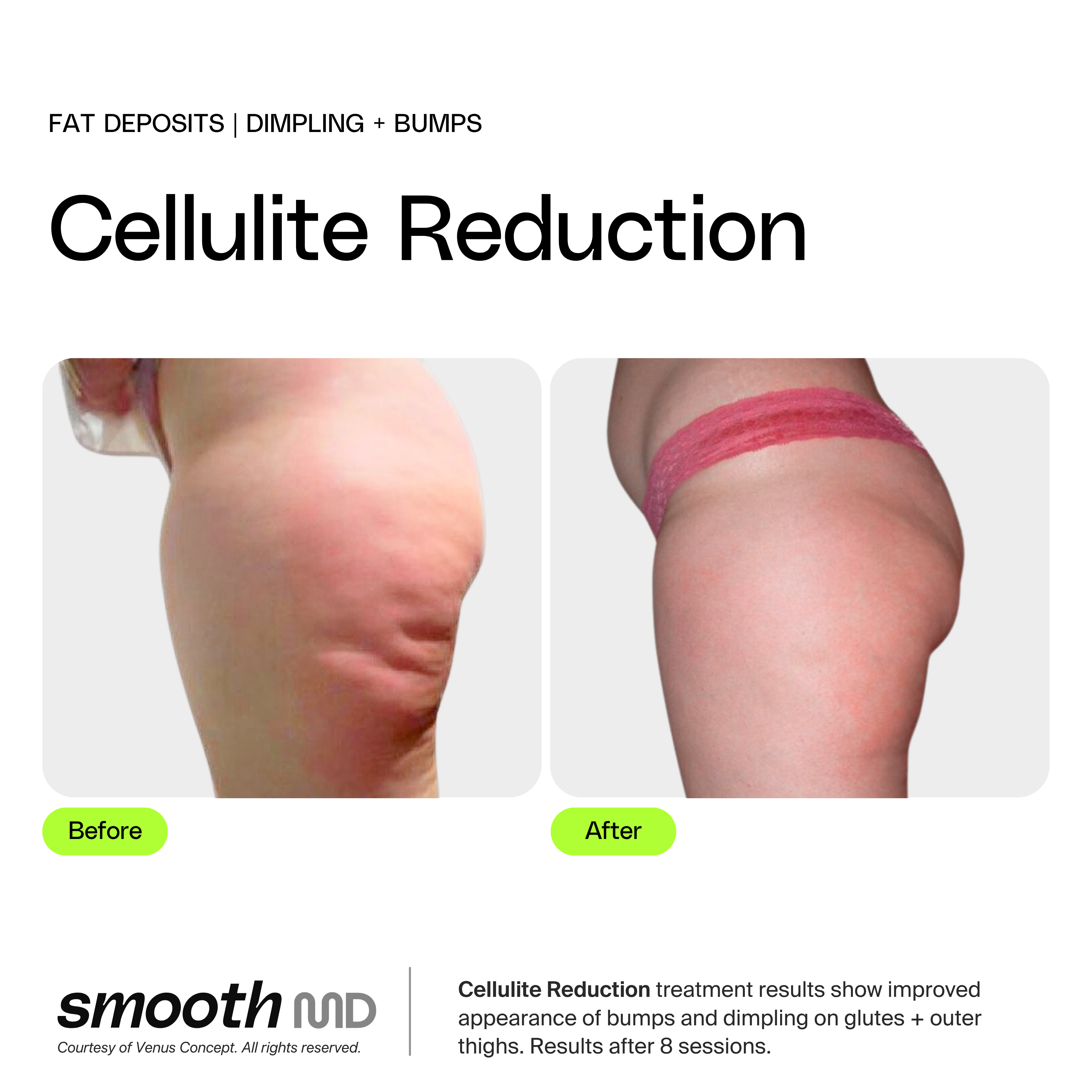 Cellulite Reduction