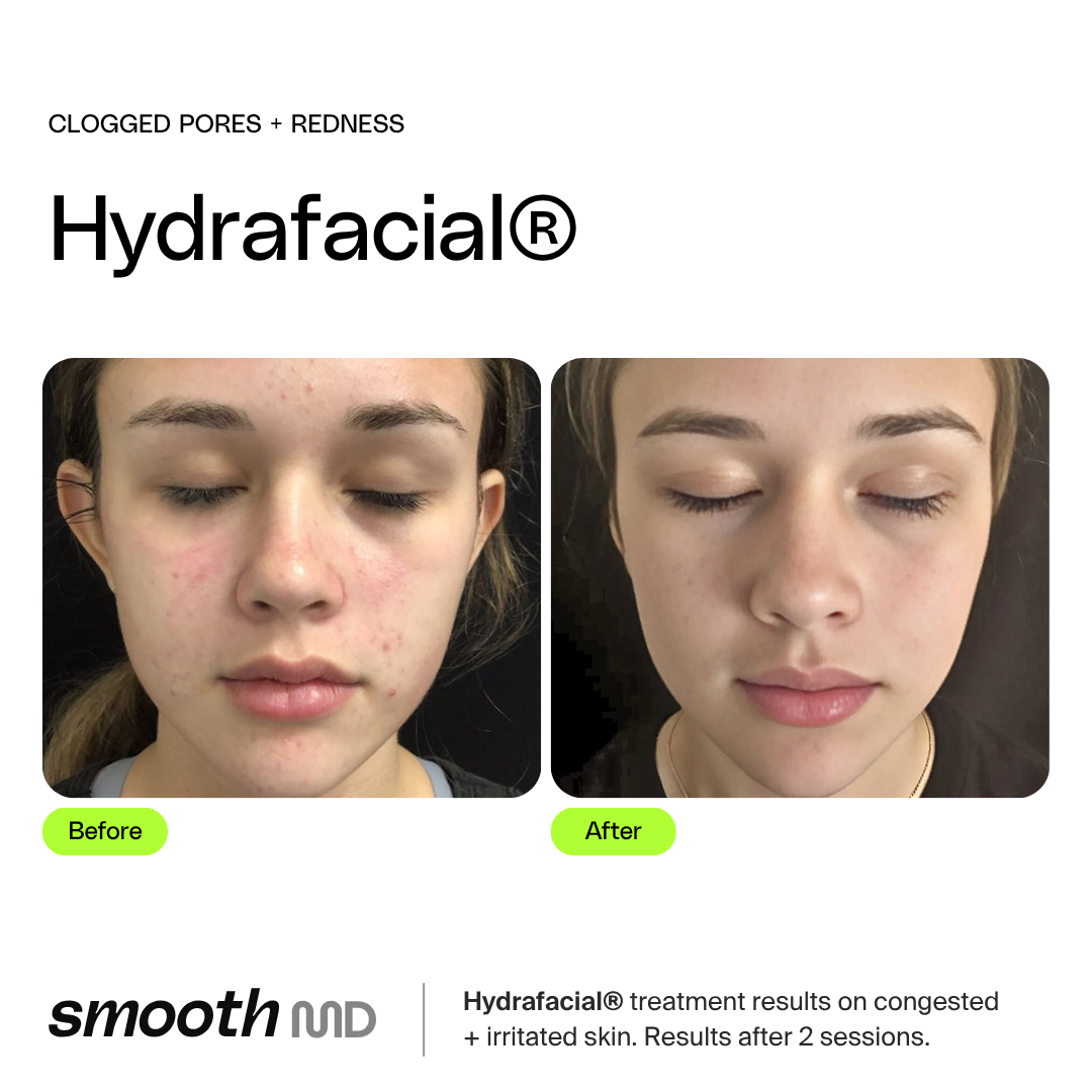 HydraFacial