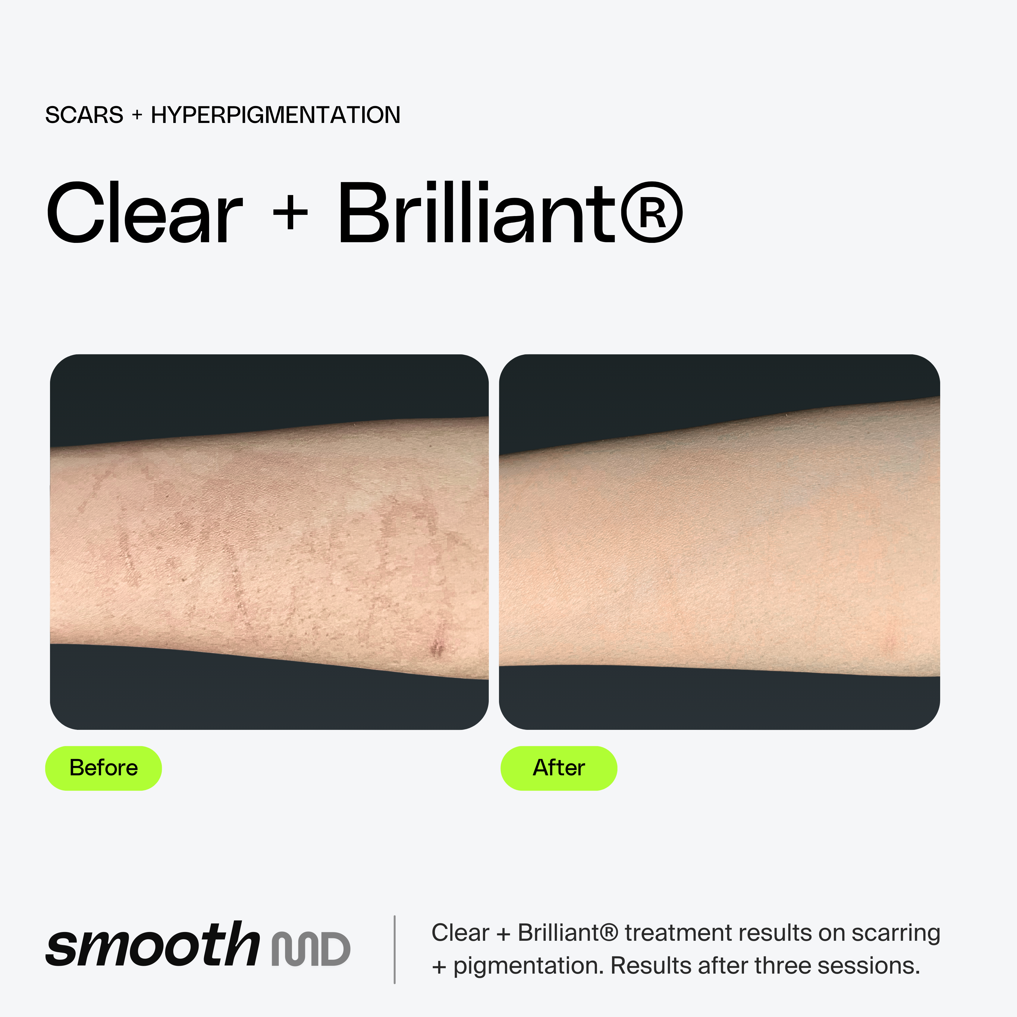 Clear + Brilliant Resurfacing Laser