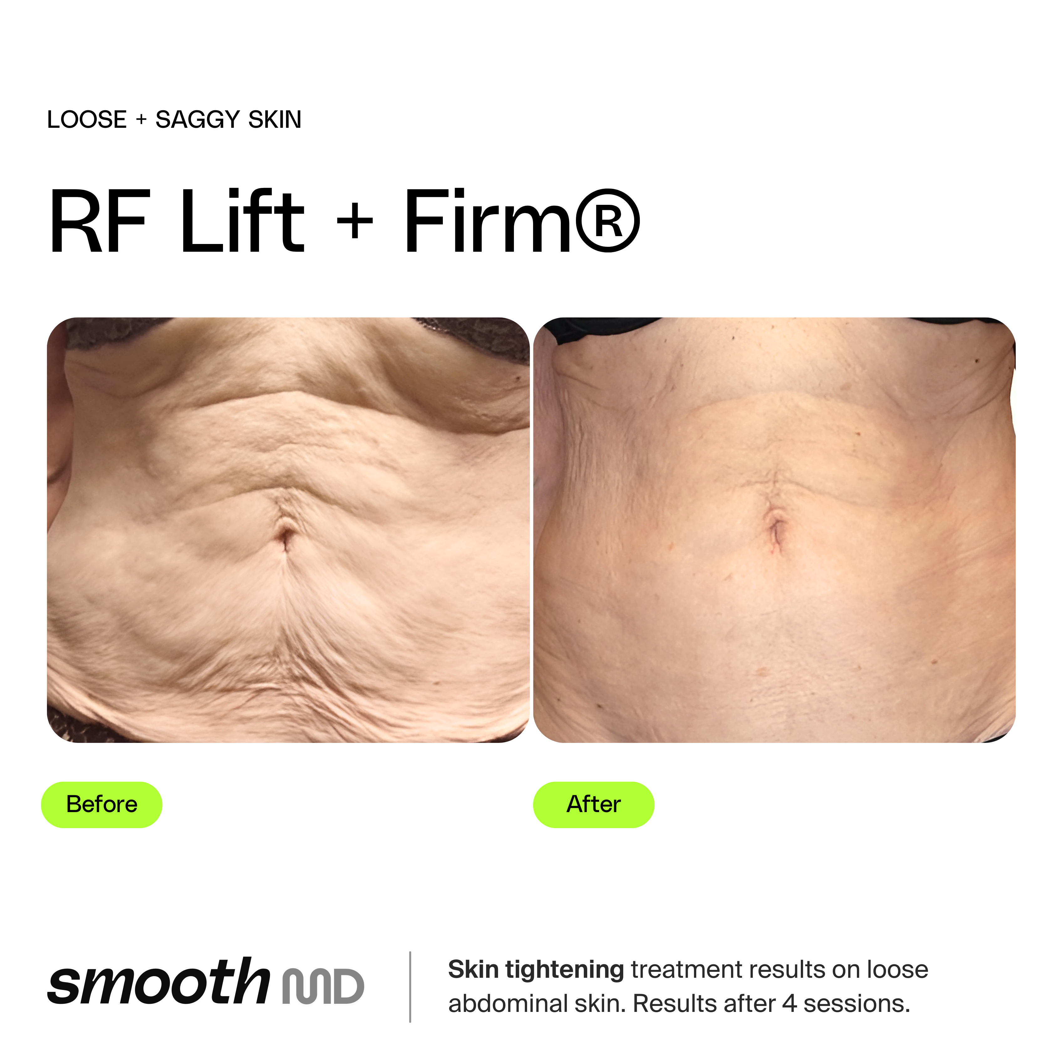 RF Body Tight