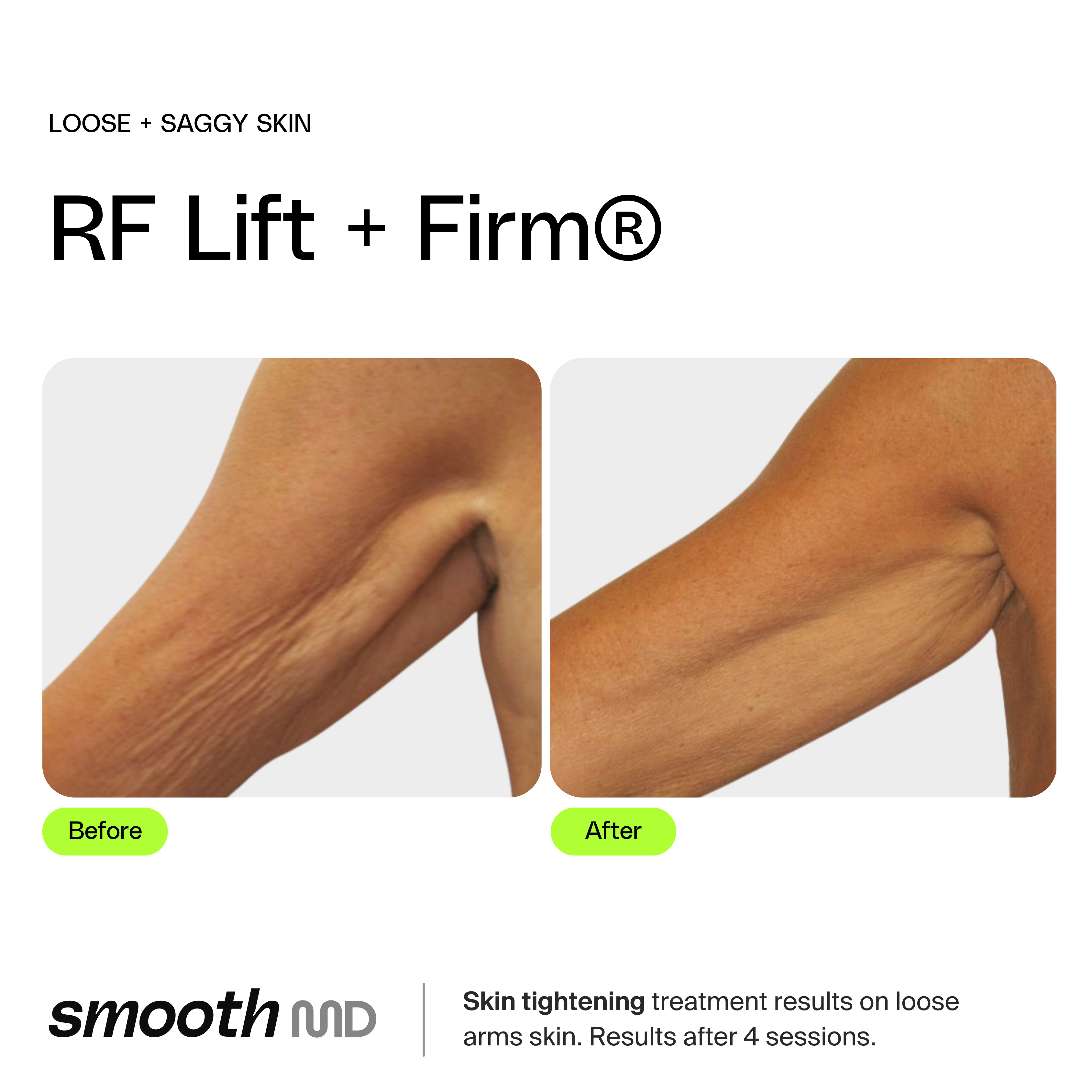 RF Body Tight