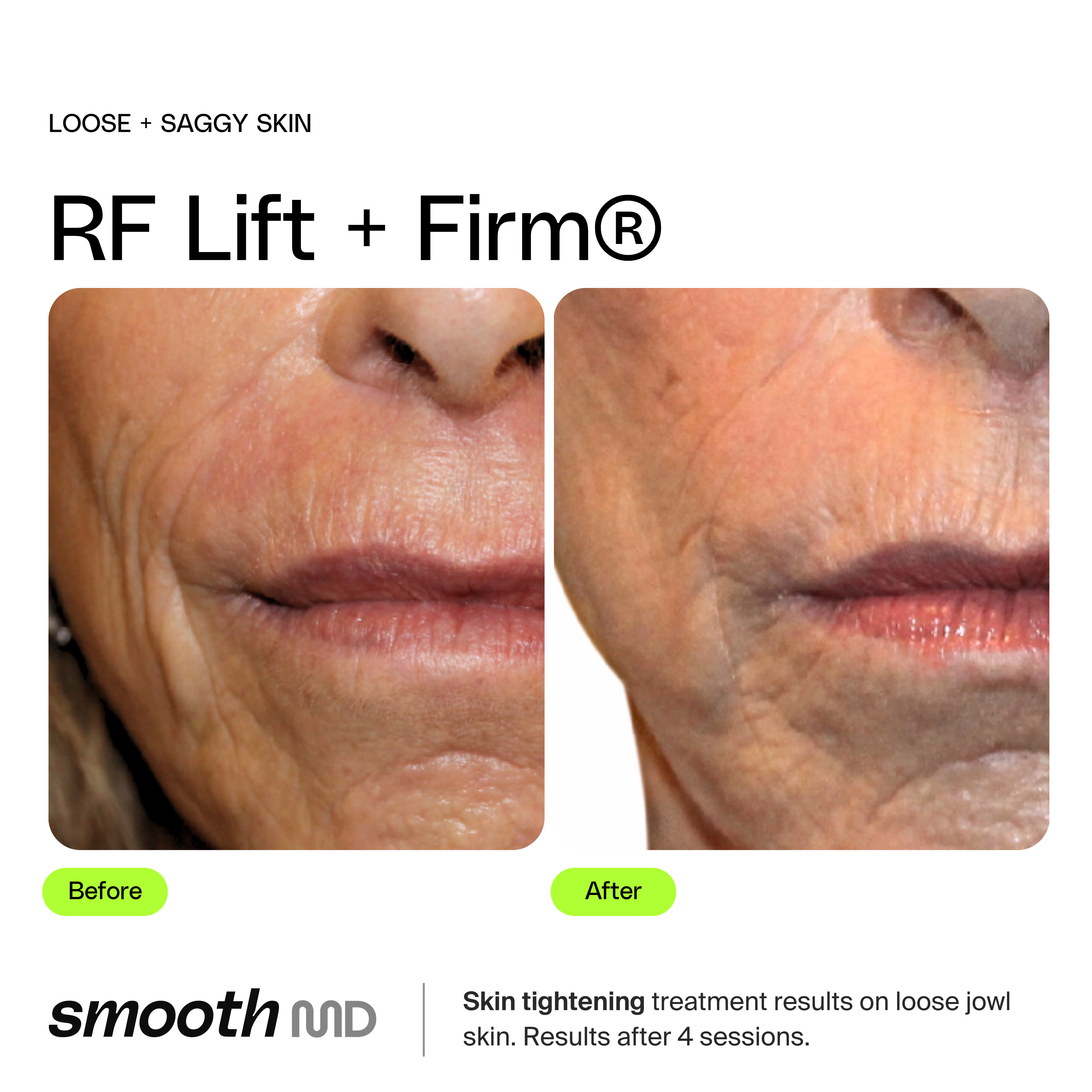 RF Face Tight