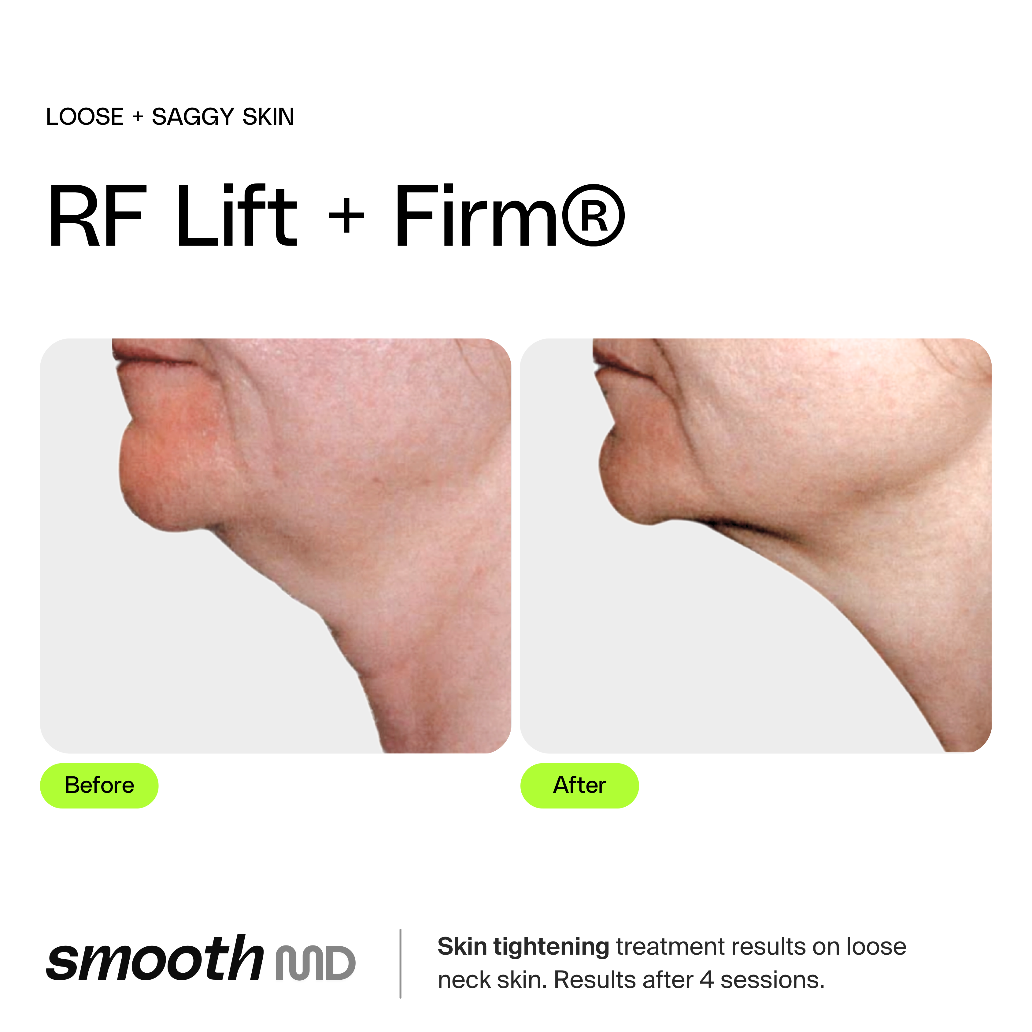 RF Face Tight