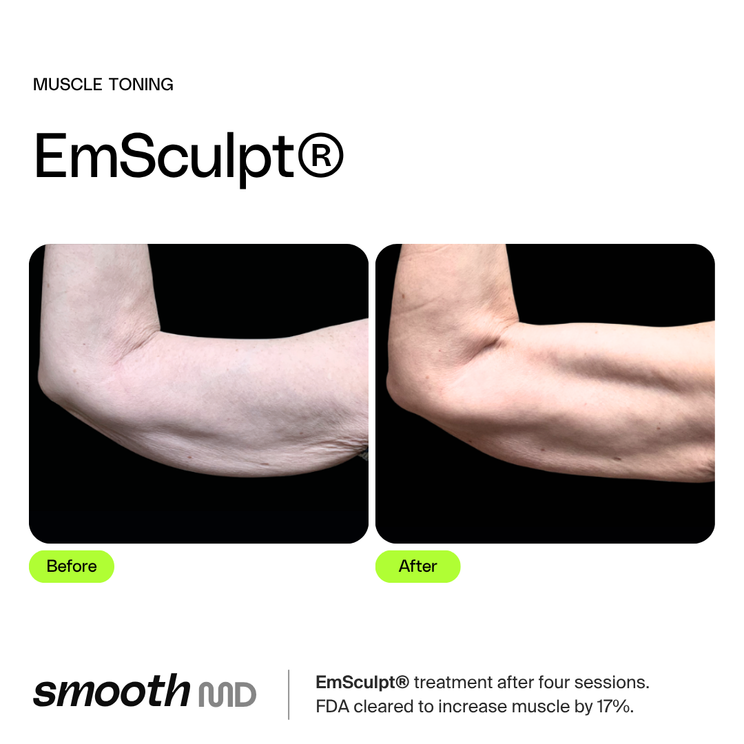 EmSculpt
