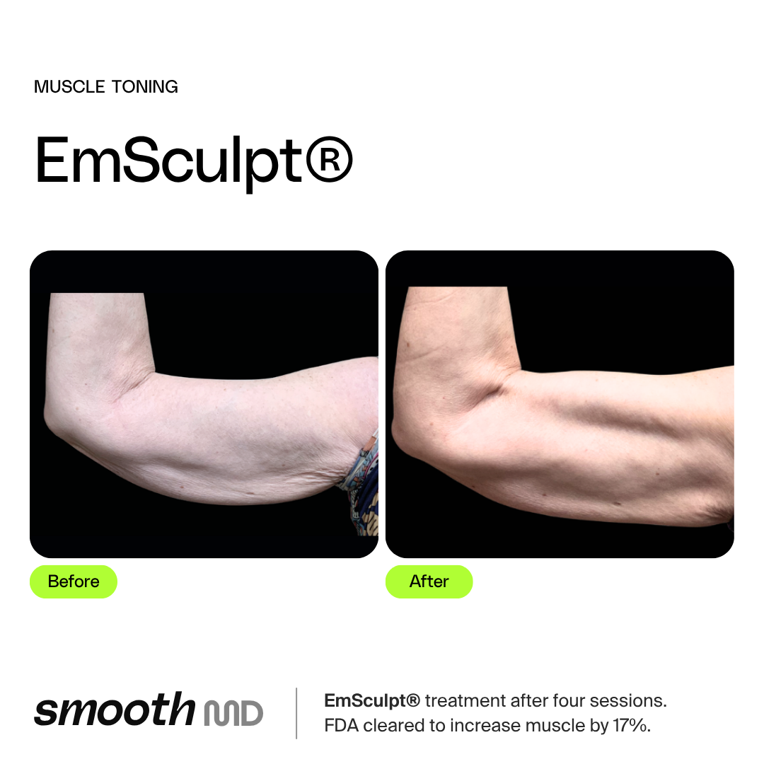 EmSculpt