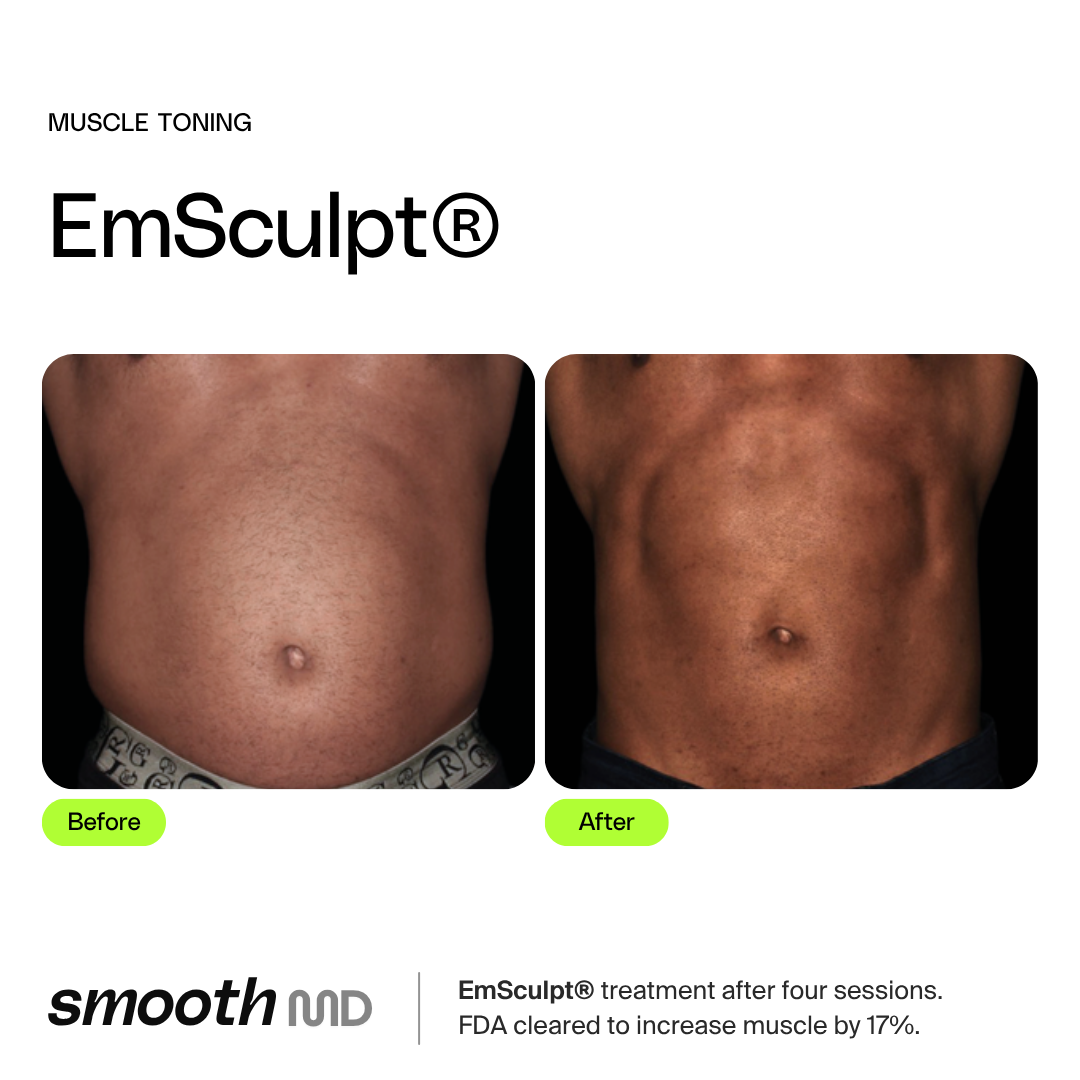 EmSculpt