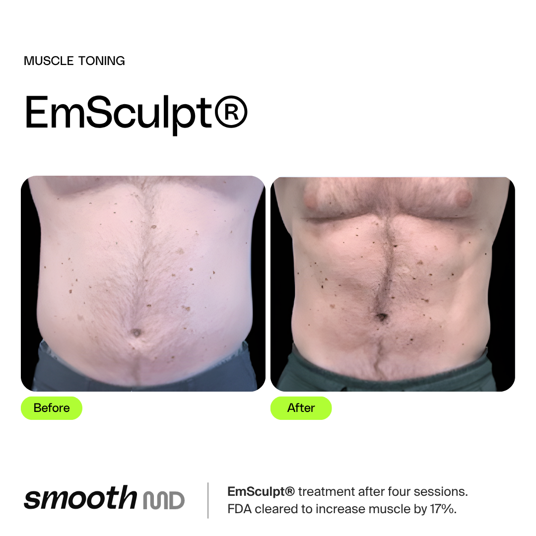 EmSculpt