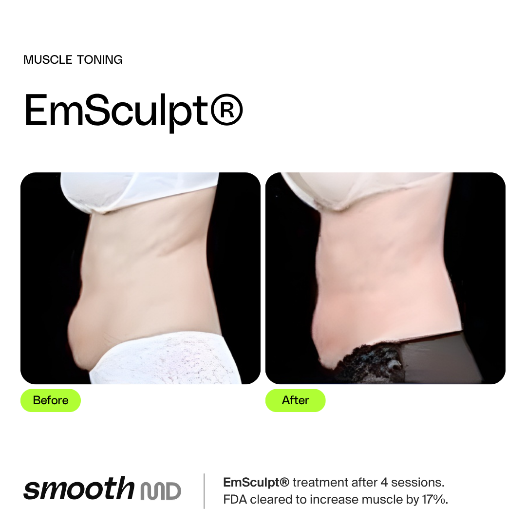 EmSculpt