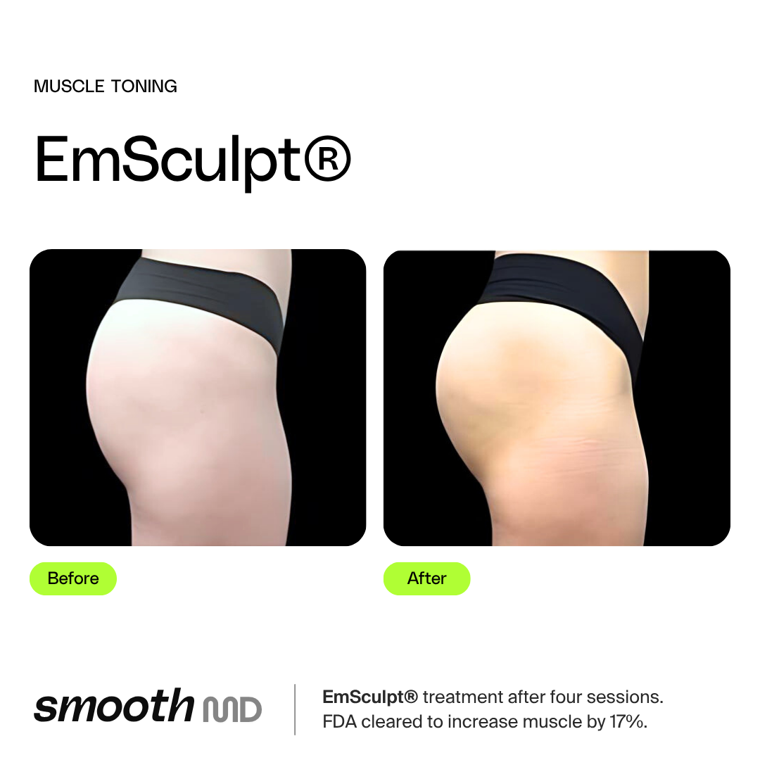EmSculpt