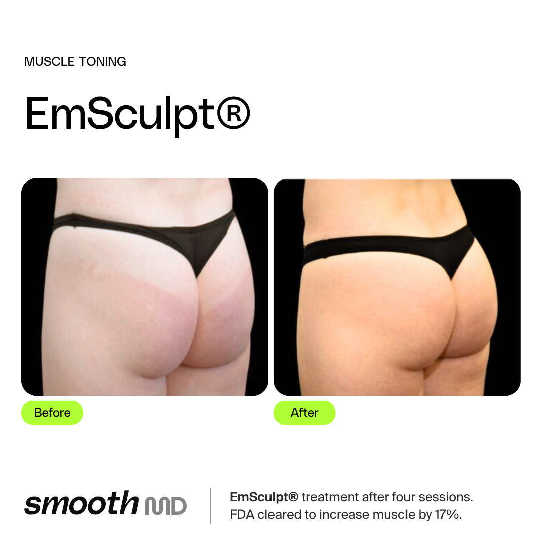 EmSculpt