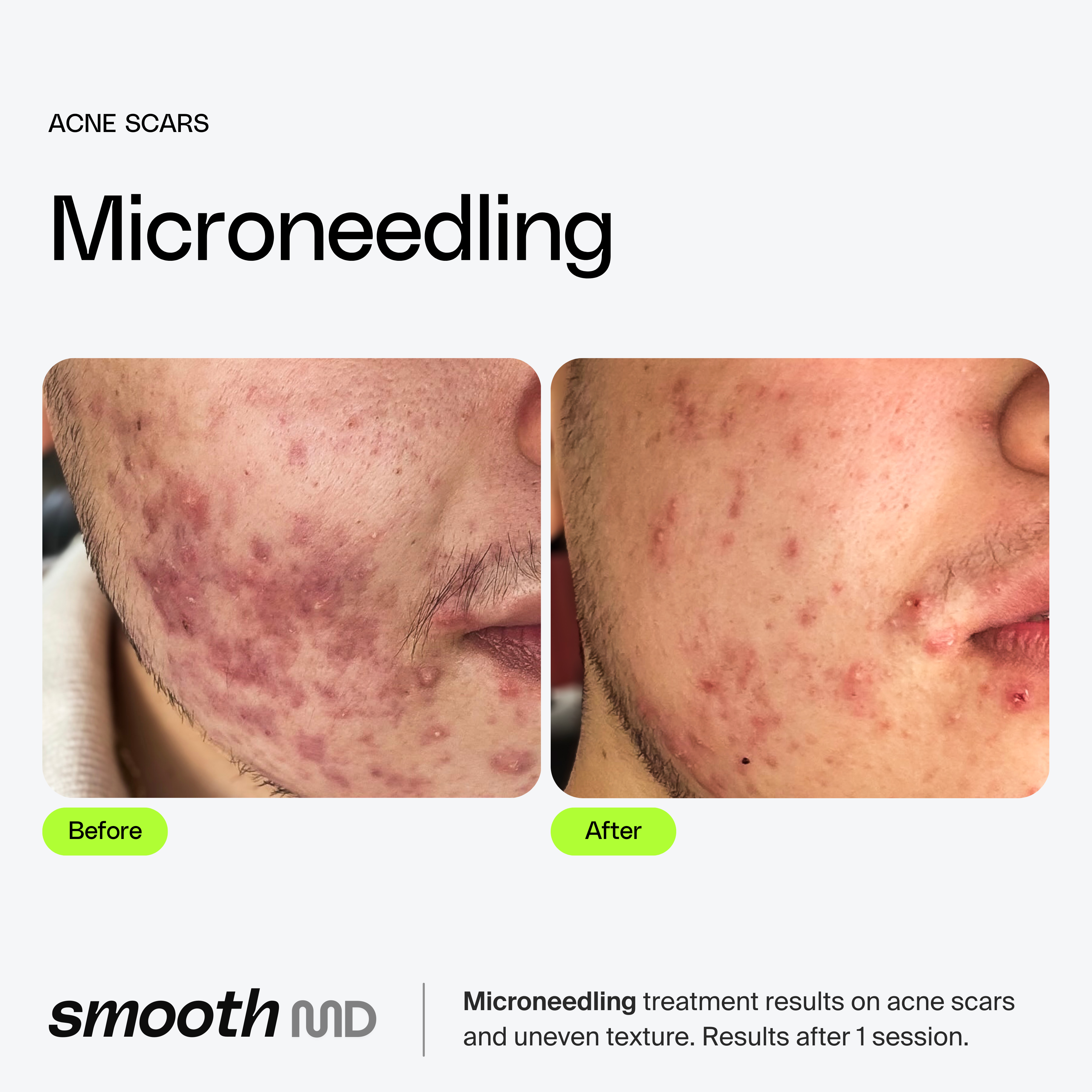 Microneedling