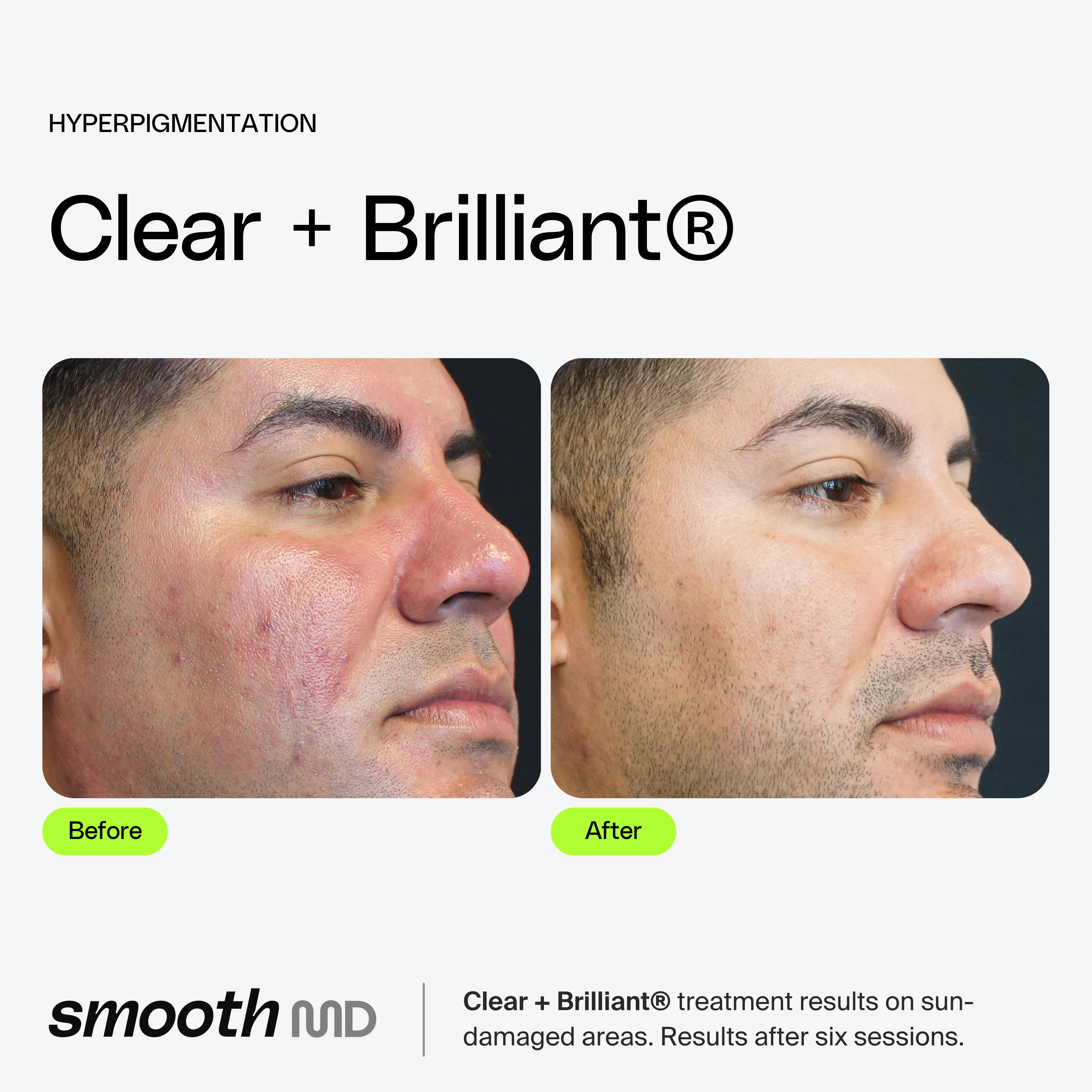 Clear + Brilliant Resurfacing Laser