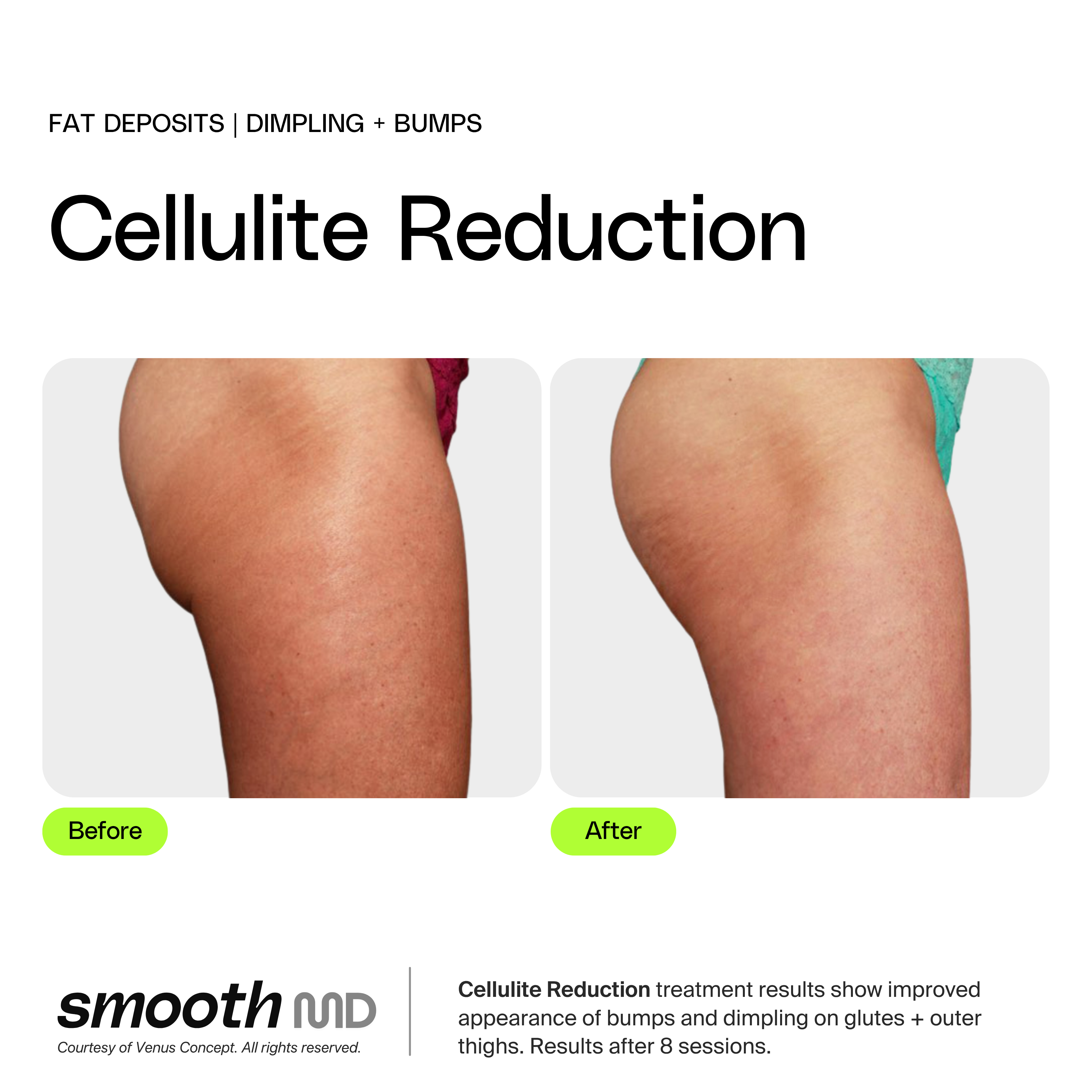 Cellulite Reduction