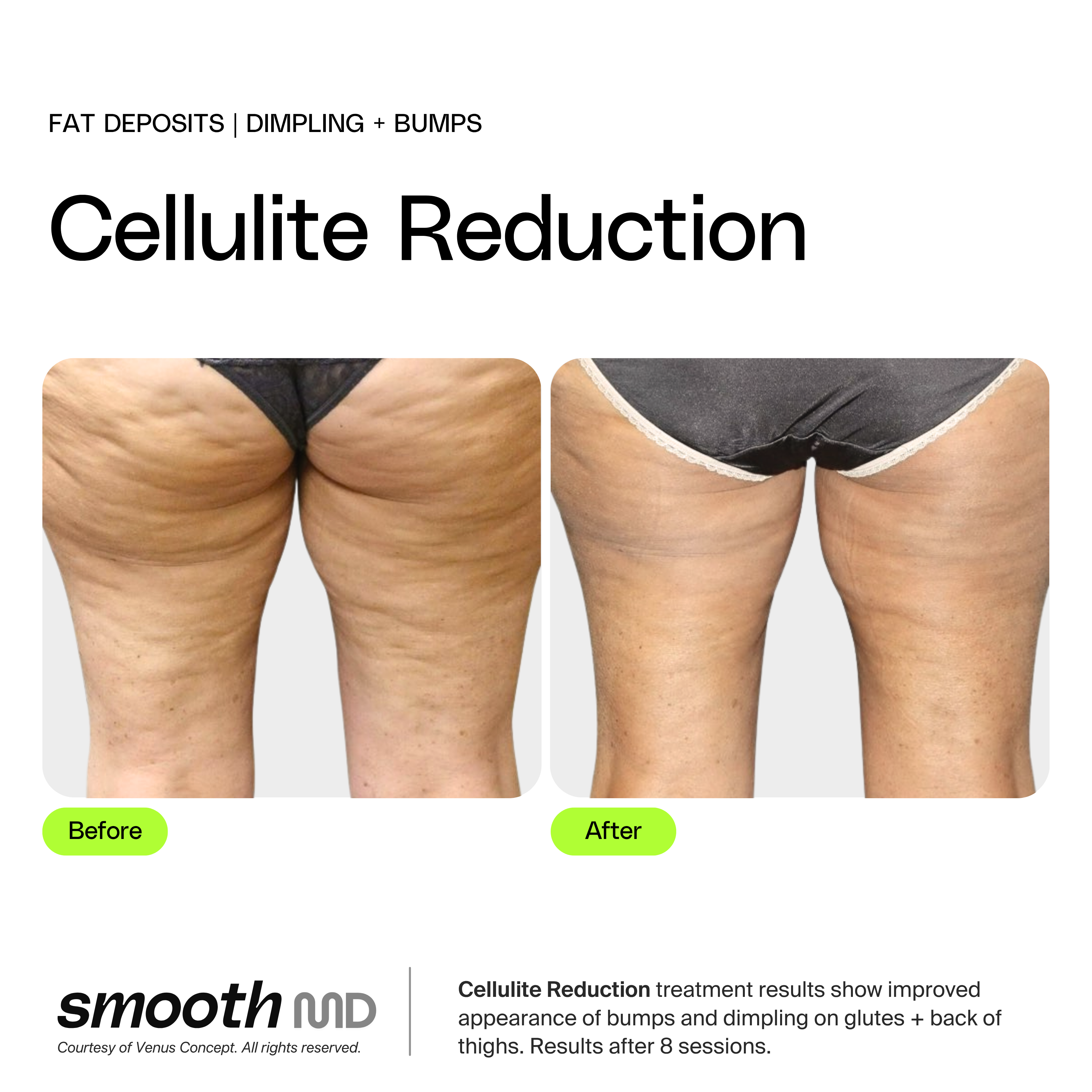 Cellulite Reduction