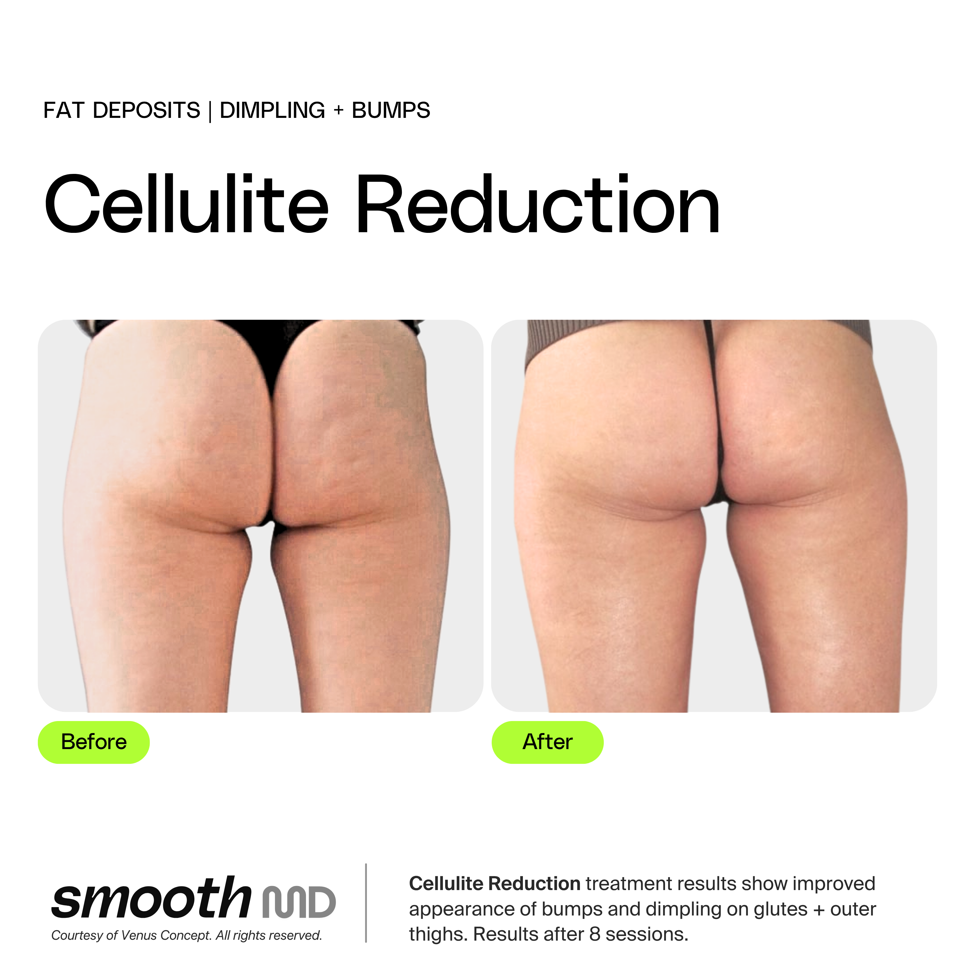 Cellulite Reduction