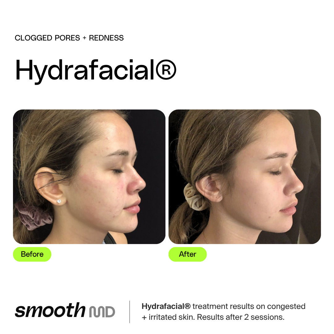 HydraFacial